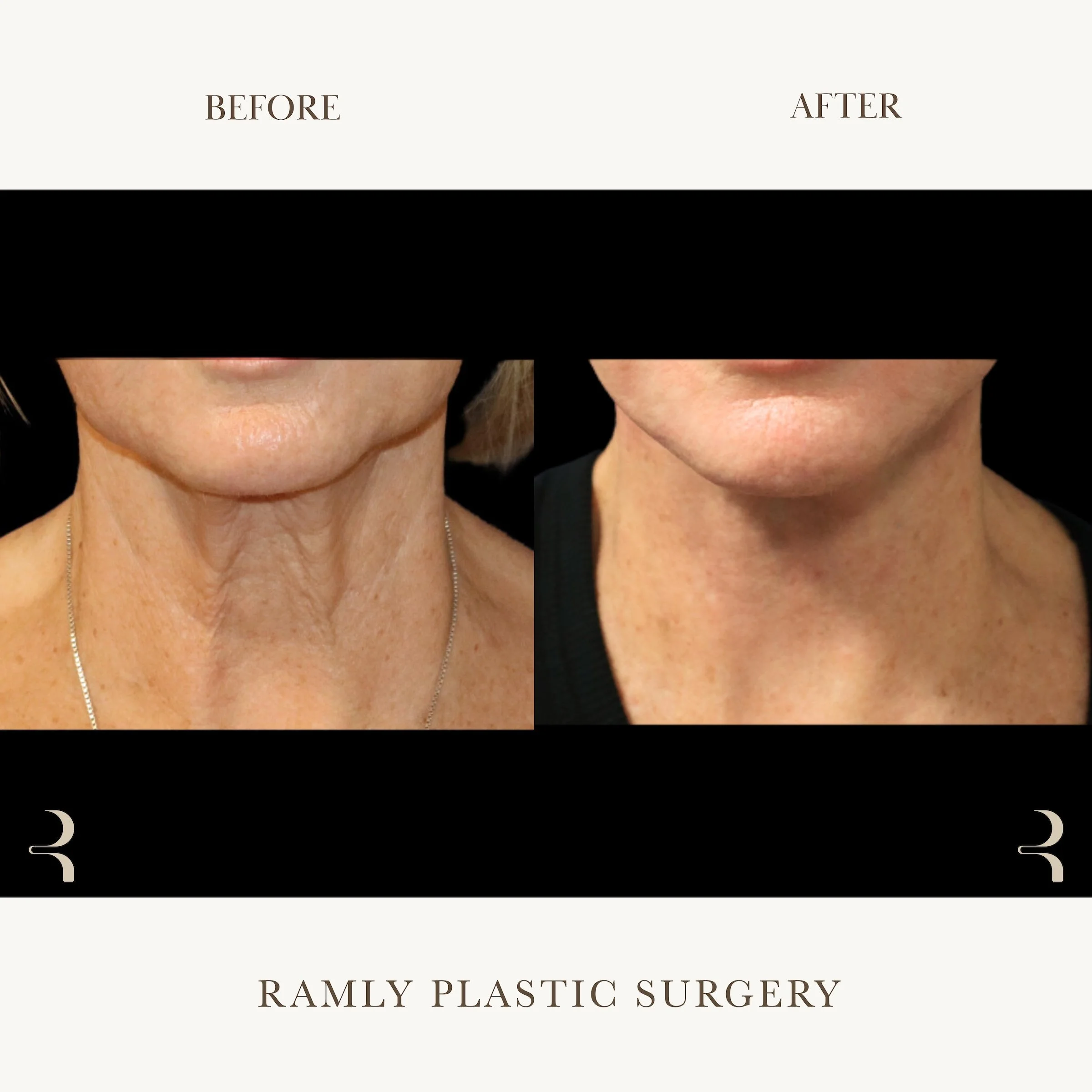 Facelift and Neck Lift Beverly Hills | Jawline & Neck Results | Dr. Elie Ramly