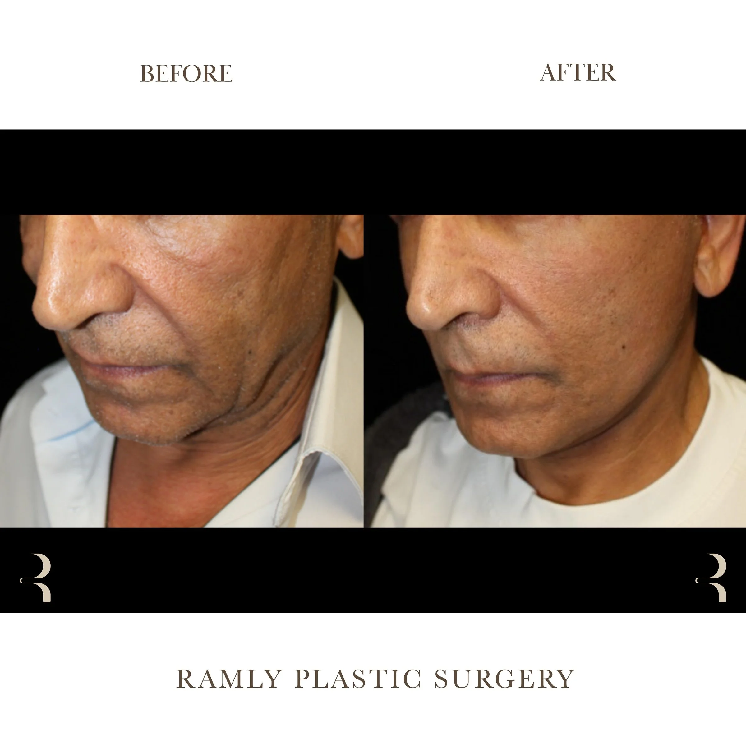 Male facelift and neck lift and fat grafting before and after by Dr. Elie Ramly in Beverly Hills showing defined jawline and neck, replenished cheek volume, and natural masculine face and neck contours.