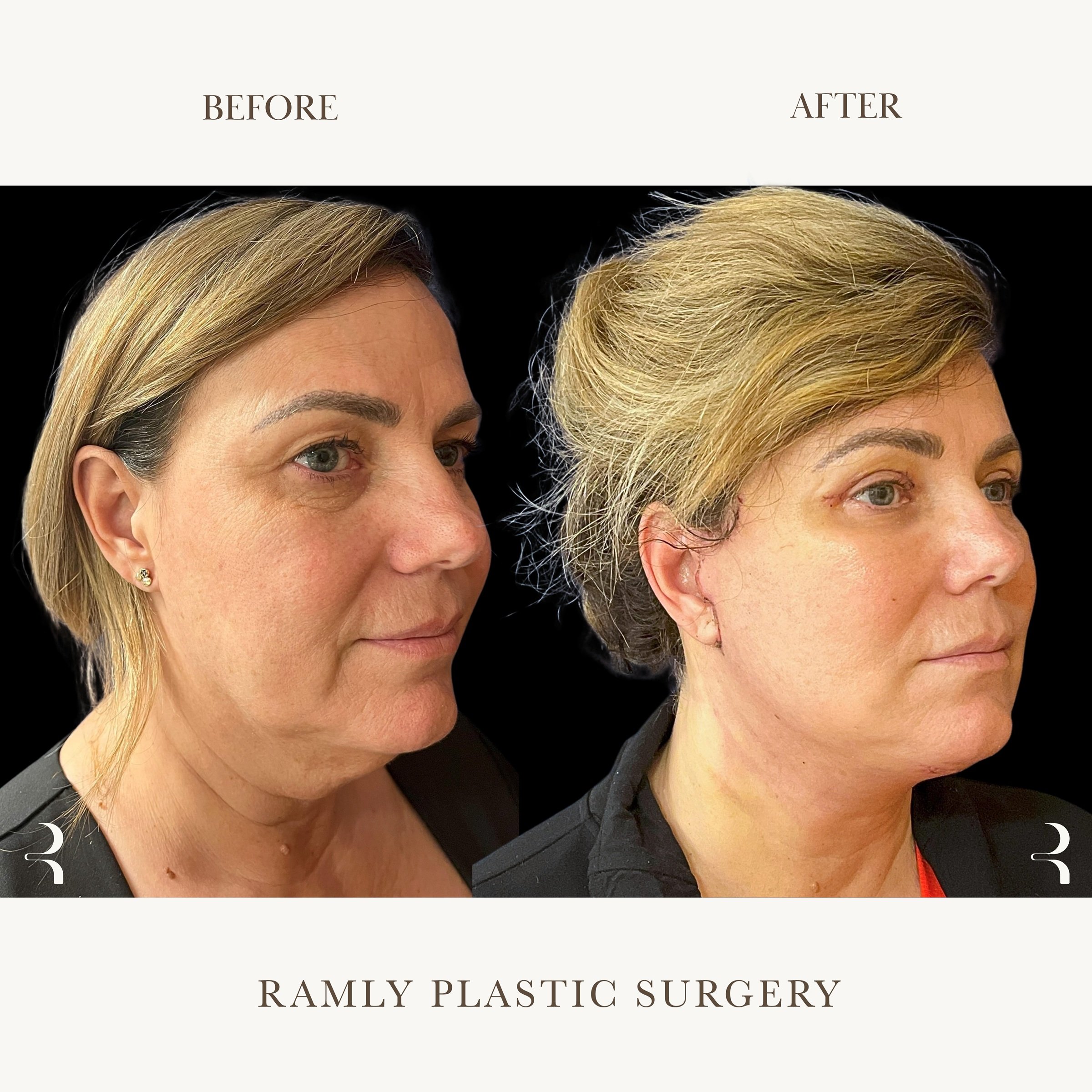Facelift, neck lift, and upper blepharoplasty before and after by Dr. Elie Ramly in Beverly Hills showing natural jawline, neck contour, and refreshed eye appearance.