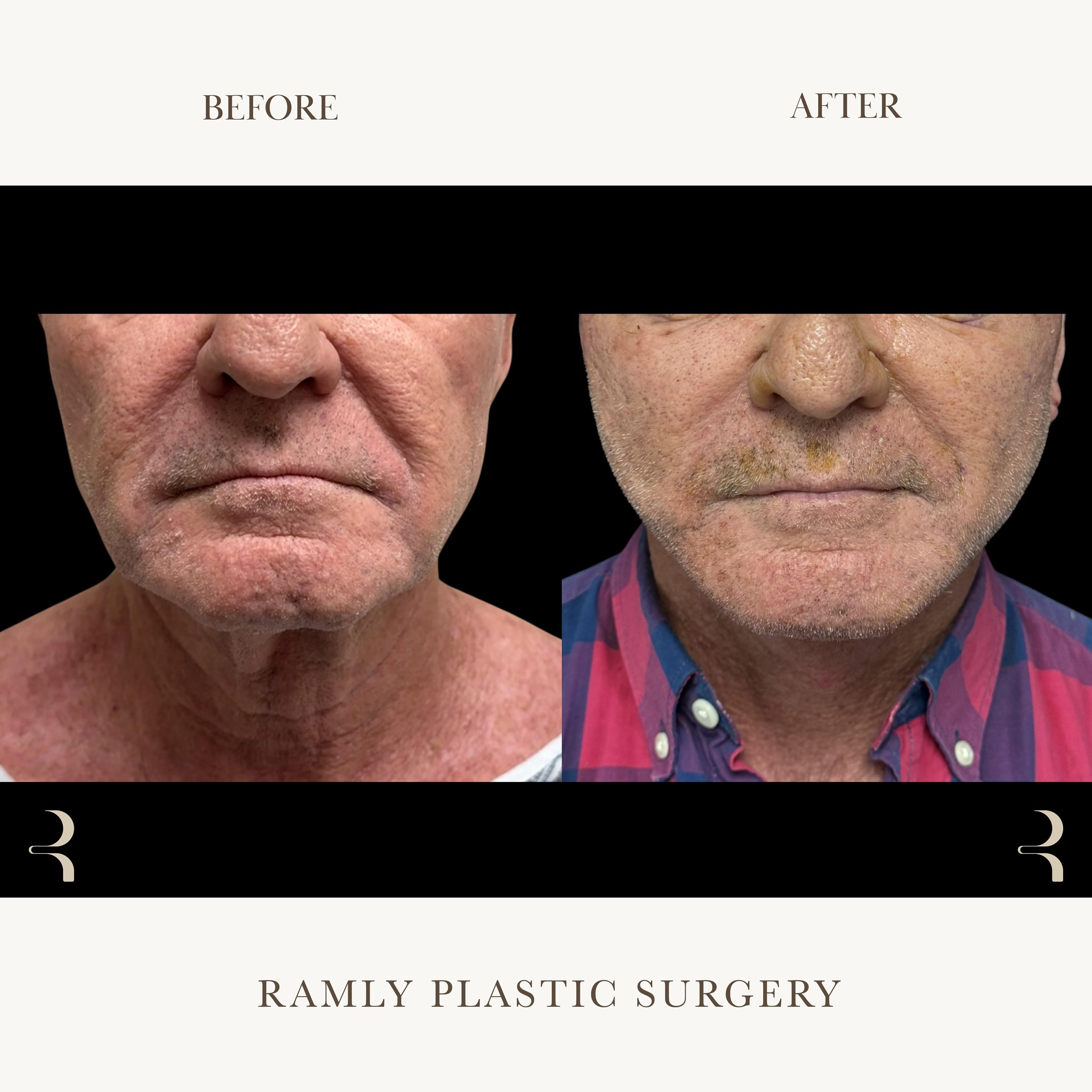 Male facelift and deep plane neck lift before and after in Beverly Hills by Dr. Elie Ramly showing improved jawline definition, reduced jowls, and refined neck contour with natural masculine results