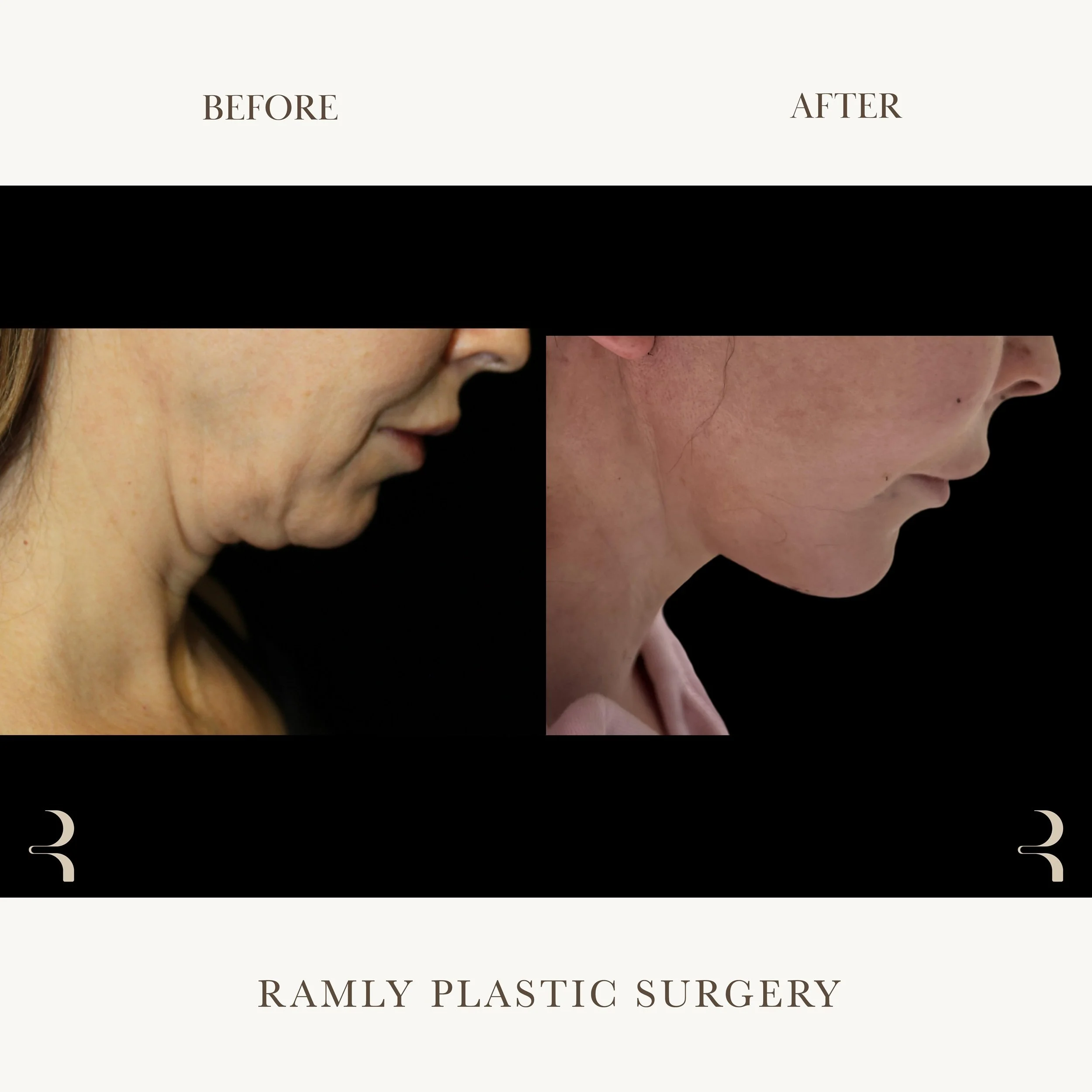 Facelift and deep plane neck lift before and after in Beverly Hills showing feminine neck contour and cervicomental angle restoration