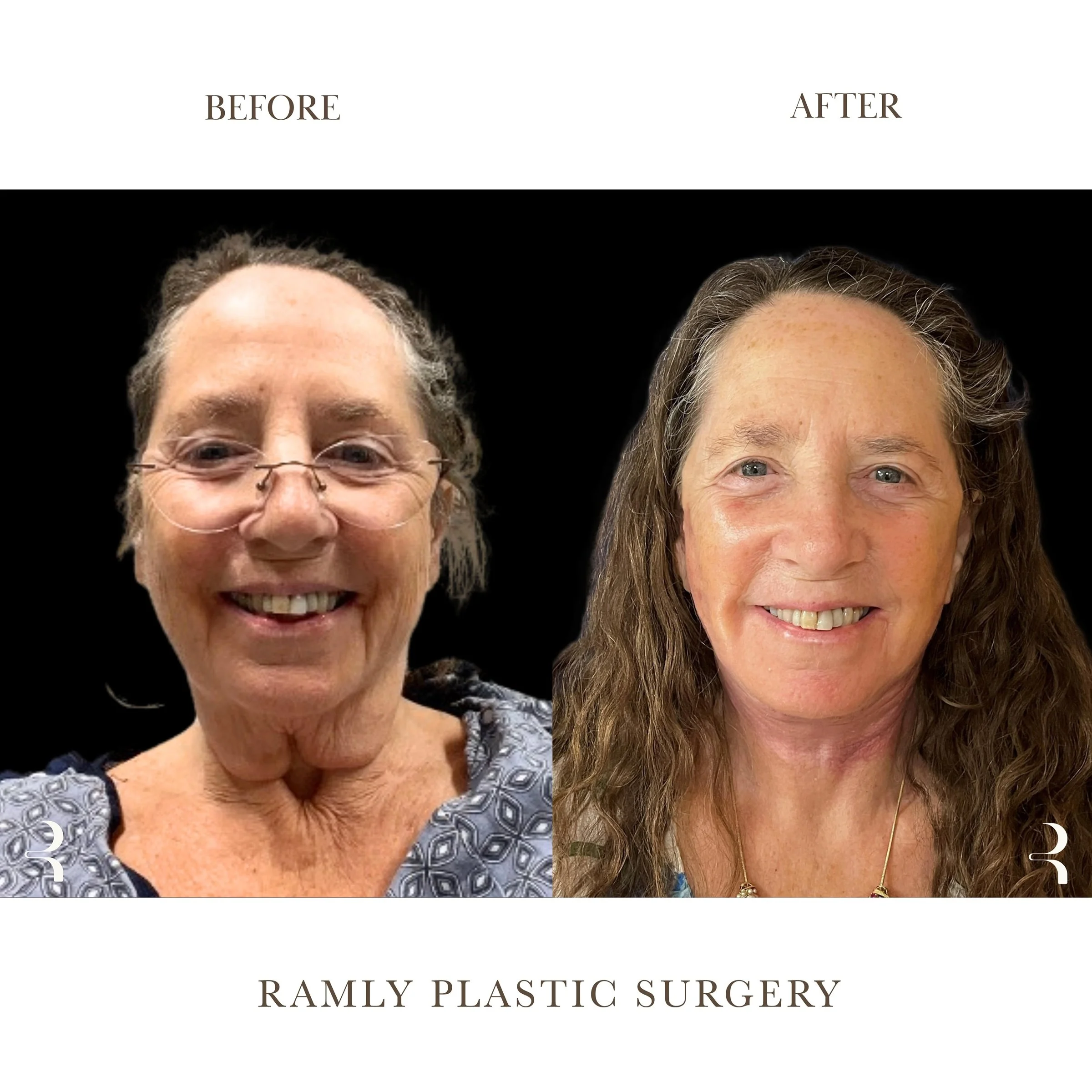 High SMAS Facelift Beverly Hills | Natural Results | Dr. Elie Ramly