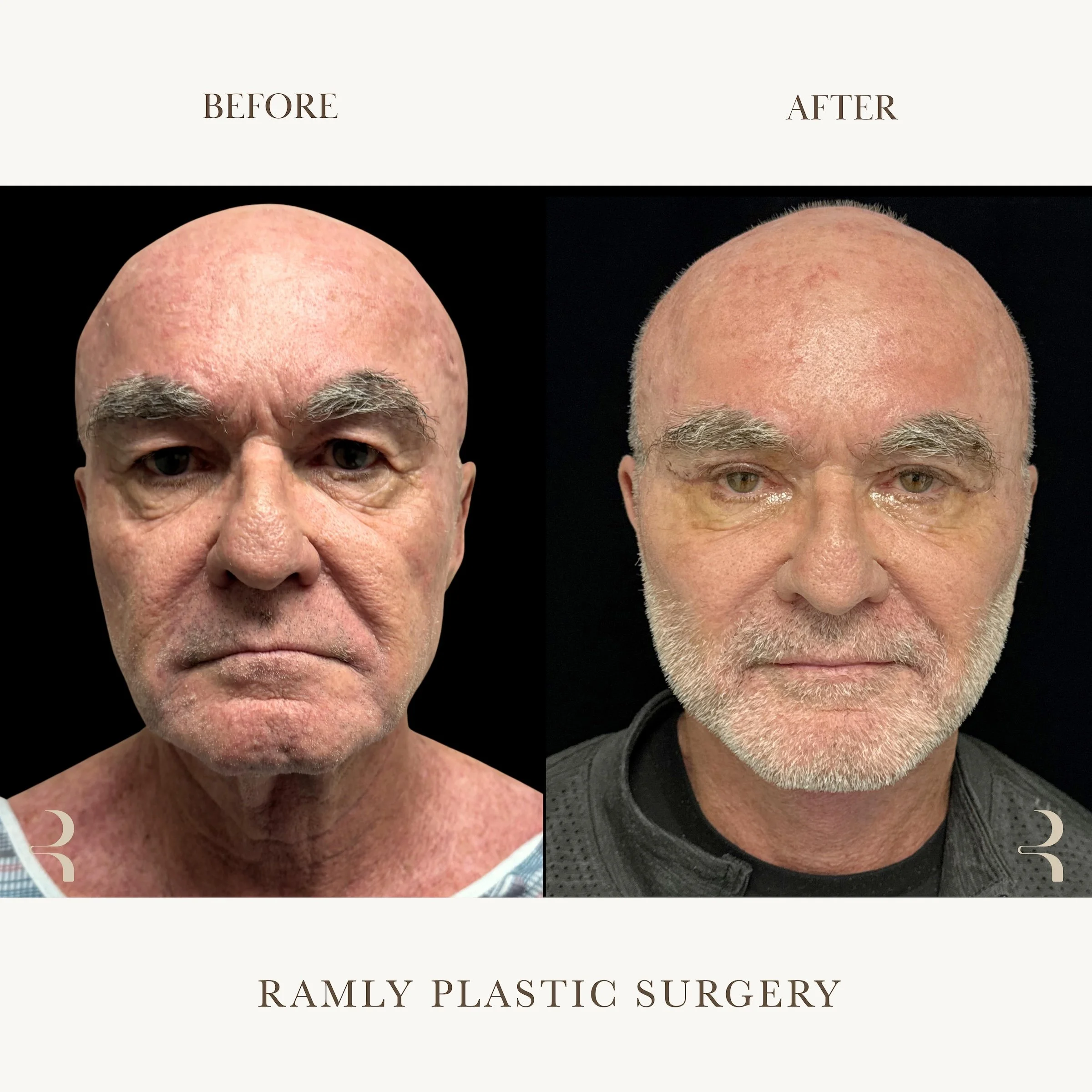 Male Facelift, Neck Lift & Upper Blepharoplasty Beverly Hills (SMAS / Deep Plane) | Ramly