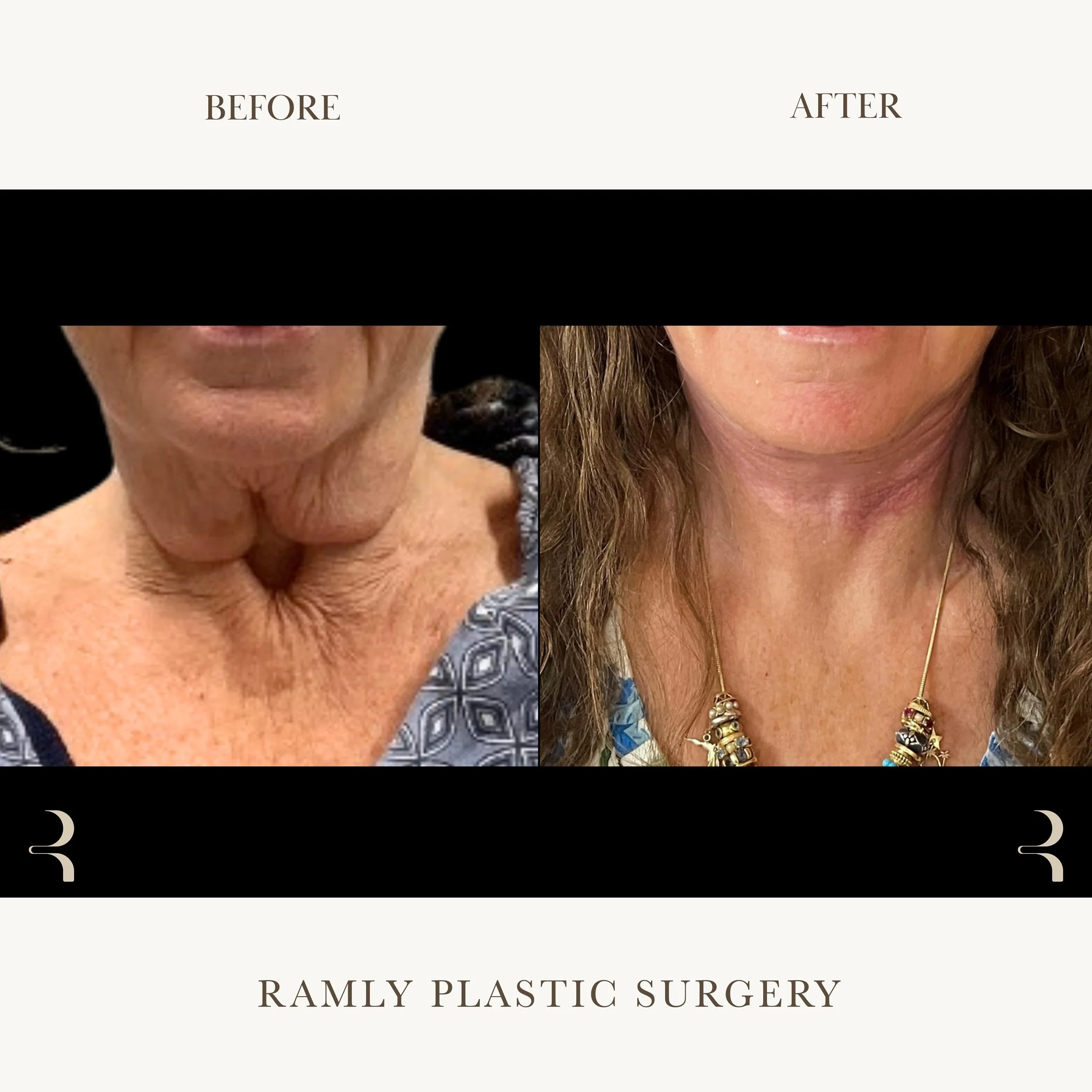 Deep Plane Neck Lift Beverly Hills | Natural Results | Dr. Elie Ramly