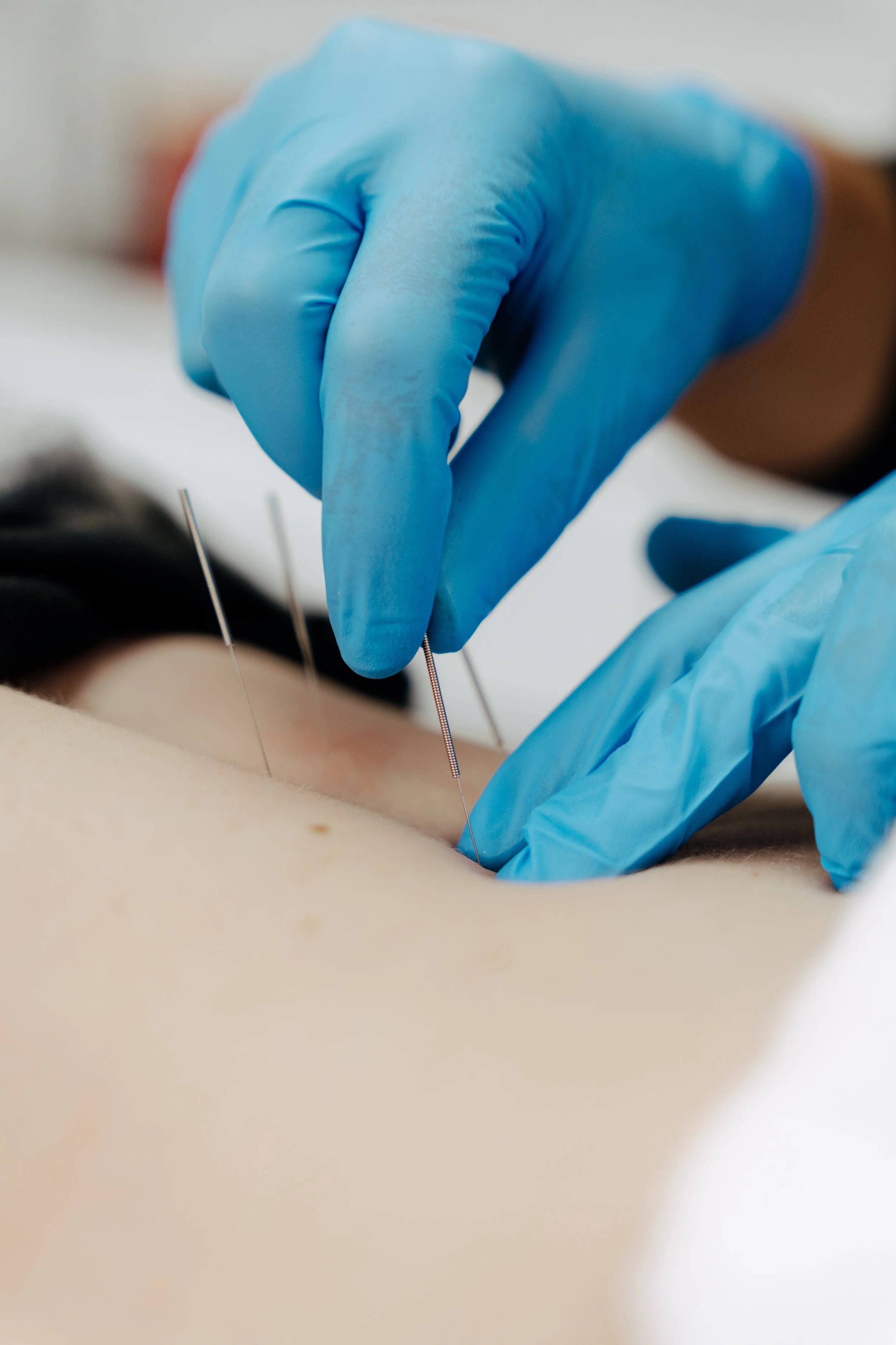 Close-up of a medical professional in blue gloves inserting acupuncture needles into a person's skin.