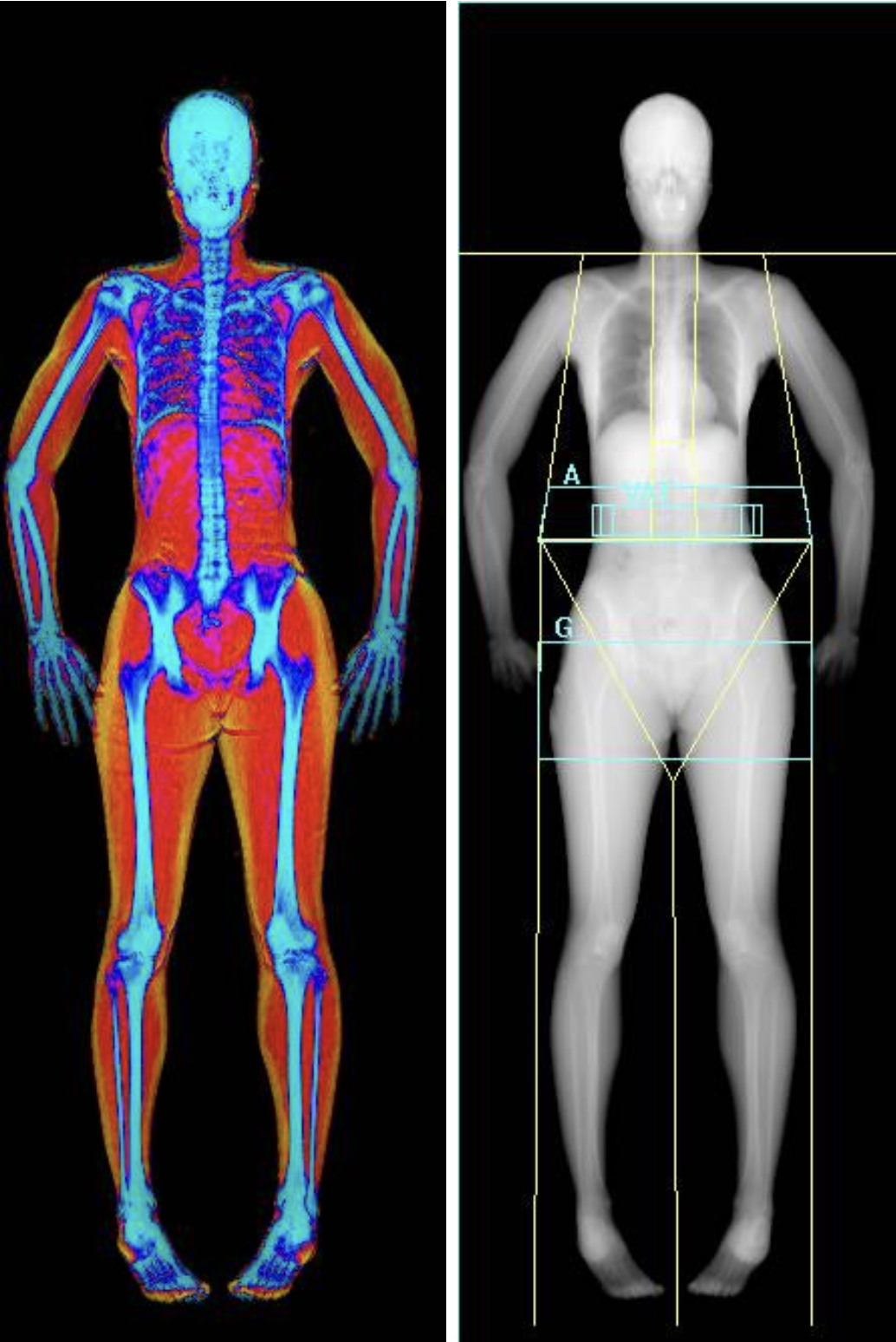 Side-by-side images of a female human body: left is a color-enhanced thermographic or medical scan highlighting bones and muscles, right is a black-and-white X-ray with measurement overlays.