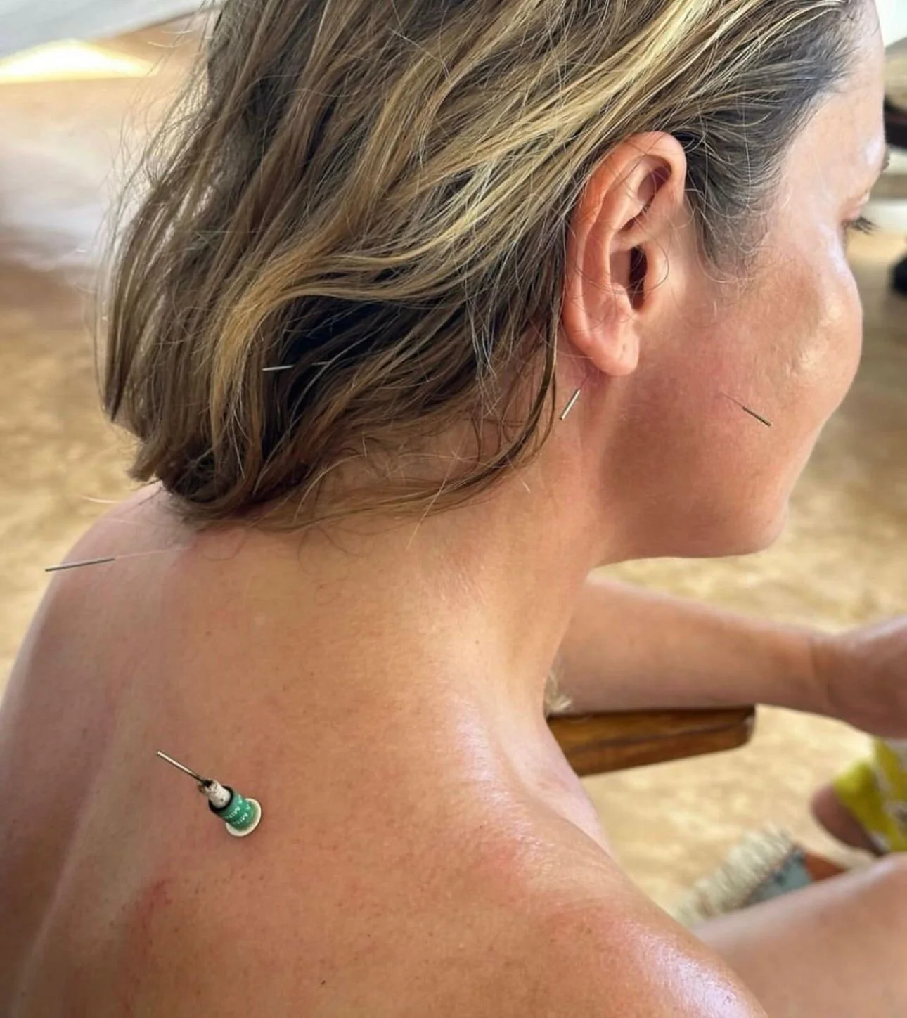 A client is recieving acupuncture and moxibustion treatment for shoulder and neck pain