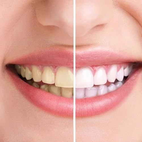 Comparison of teeth before and after whitening, showing improved whiteness and brightness in the right side.