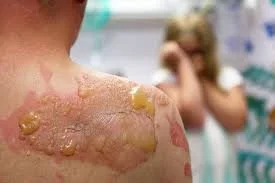 Burn Injuries After a Crash or Explosion: Why These Cases Require Experienced Lawyers