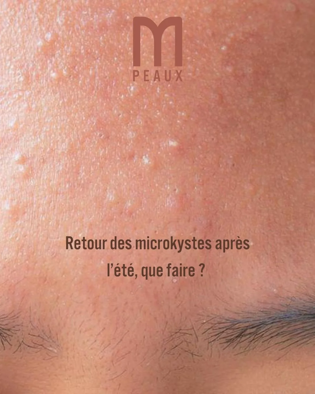 ☀️ Peau parfaite en &eacute;t&eacute; ? Attention au retour de flamme.
L'acn&eacute; post-soleil, &ccedil;a vous parle ? Pendant l&rsquo;&eacute;t&eacute;, le soleil donne l&rsquo;illusion d&rsquo;une peau plus lisse, plus nette&hellip; Mais &agrave;