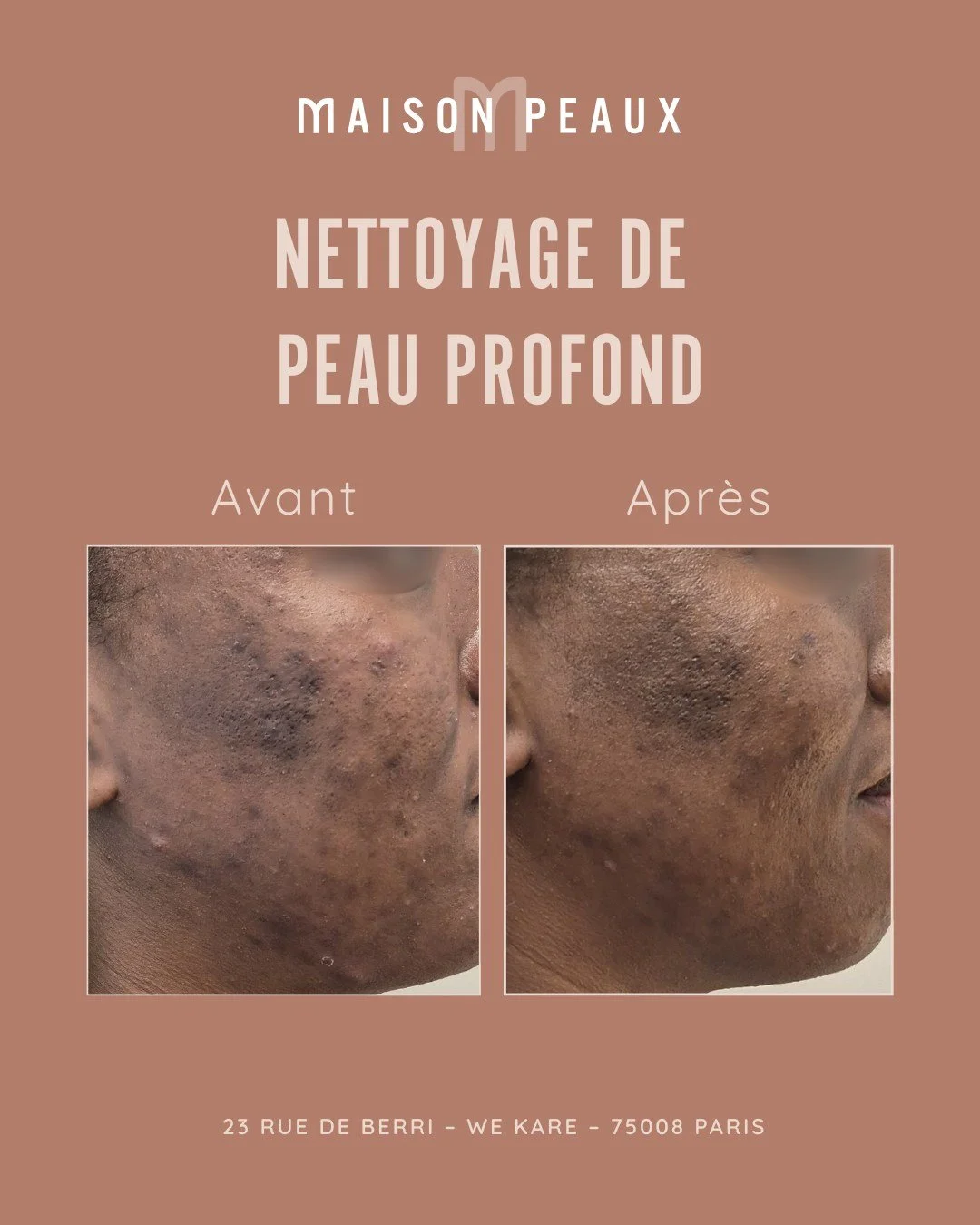 Avant/Apr&egrave;s

Une belle am&eacute;lioration apr&egrave;s un nettoyage de peau profond, associ&eacute; &agrave; des compl&eacute;ments alimentaires et notre routine cosm&eacute;tologique personnalis&eacute;e. 

R&eacute;sultat : une peau plus li