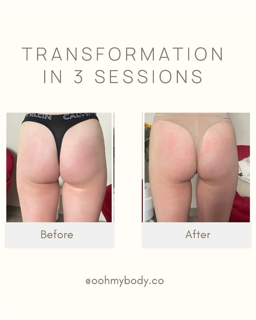 After just three sessions of Endospheres Therapy, the transformation is remarkable. 😍😍
This advanced microvibration treatment stimulates circulation, improves lymphatic drainage, and enhances skin tone — resulting in visibly smoother, firmer