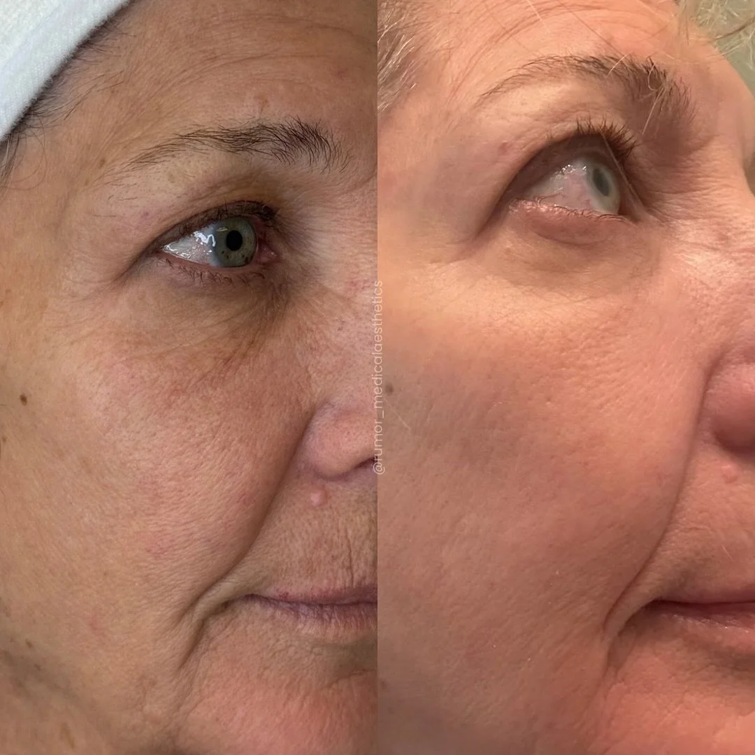 ‼️ STOP SCROLLING. This is not a drill, and it’s definitely not a filter.
After just ONE expert-led treatment with our breakthrough resurfacing laser, our client achieved results that are truly worth talking about. We saw significant, measurab
