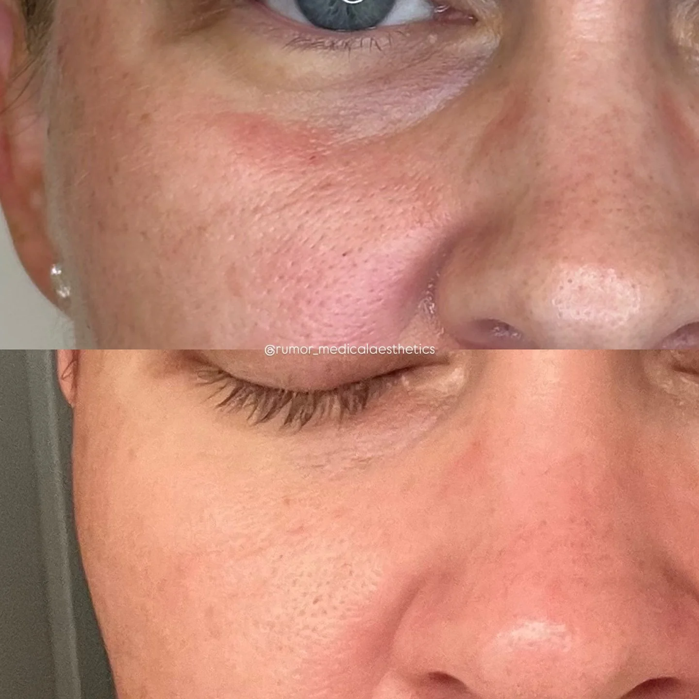 Pores, texture, pigment? We don’t know her ✌️⚡️
One treatment in — and we’re already obsessed. Each day brings us closer to the official launch of our new resurfacing laser, and trust us… it’s about to take our results