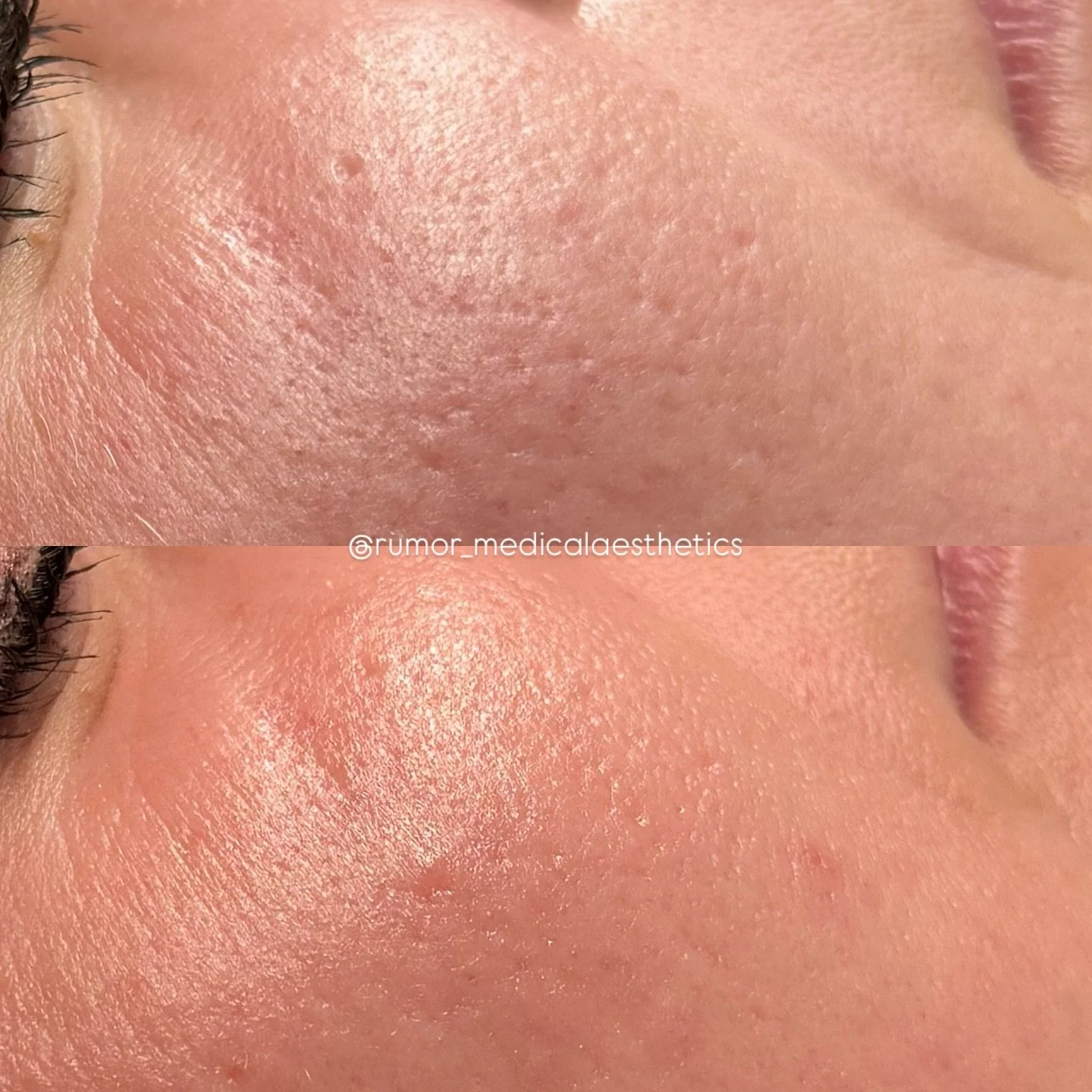 When we say consistency and patience are everything, this is exactly what we mean. 👏✨

Pores. Scarring. Texture. Clarity. ✔️

At Rumor, we love a thoughtful multi-modality approach. For this client, we paired Microneedling with our signature Glass S