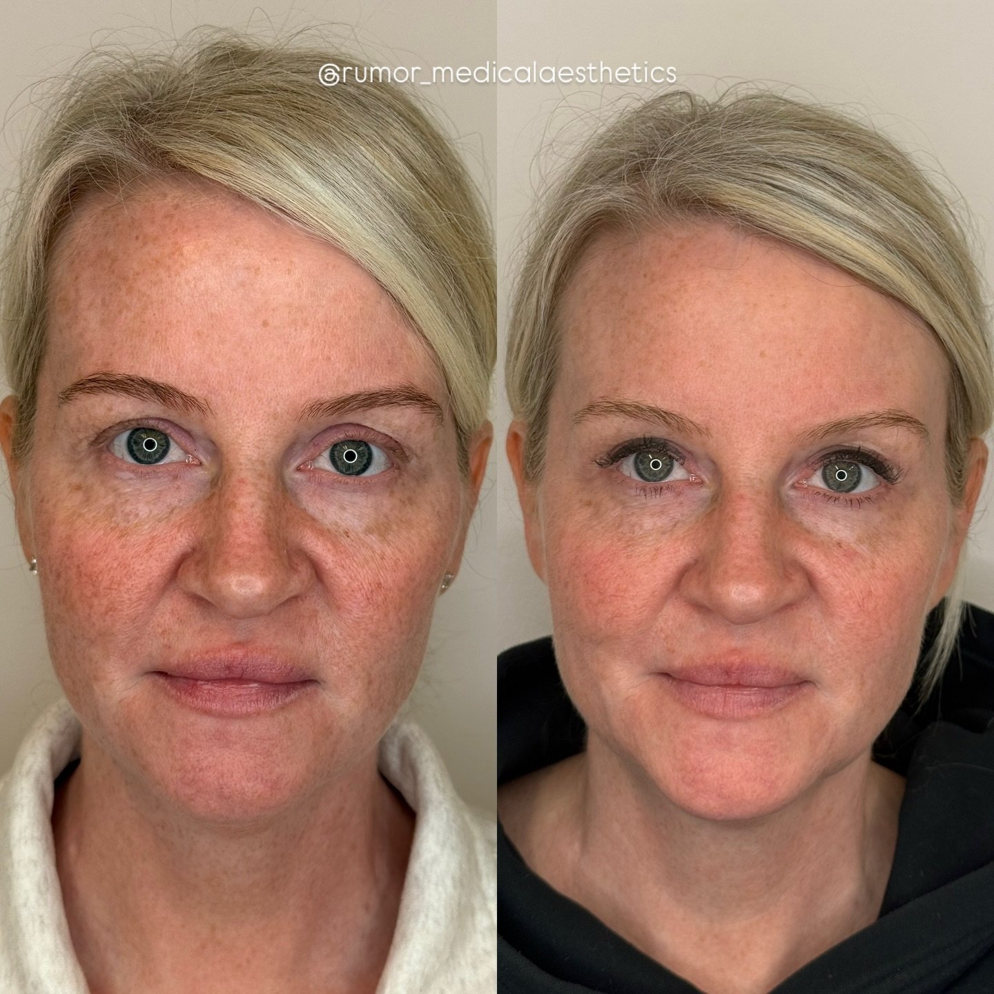 👀 Rumor has it&hellip;these Reset results could speak for themselves

This before + after was achieved with just 1 of our signature Rumor Reset resurfacing laser treatments. These photos were taken 4 weeks apart! But the real secret? Pairing in-offi