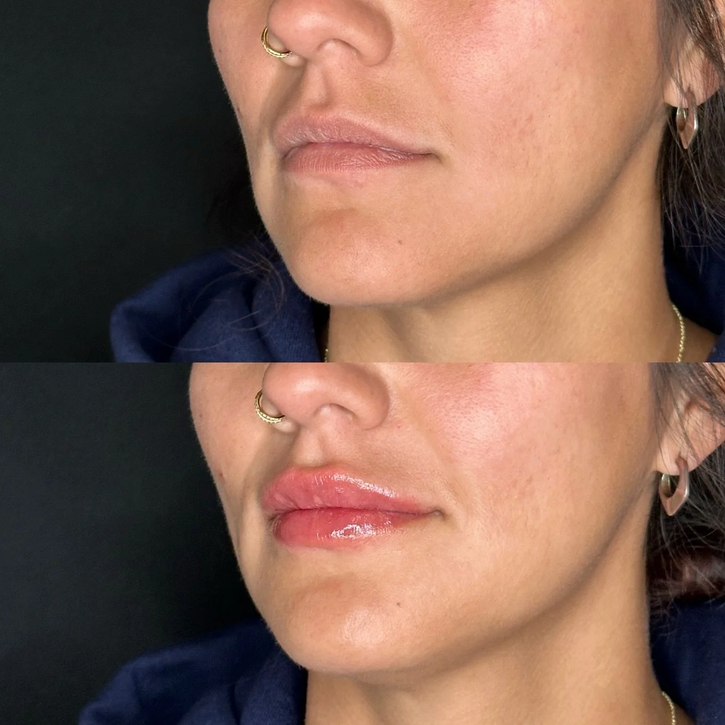 A little volume, a lot of confidence 💋💉

✨ Rumor Medical Aesthetics 
📍Rock Hill, SC
📲 803-919-1958
🕸️ www.rumoraesthetics.com

💉Lynda Marovich, MSN, FNP-BC
@lynda.therumornp 
⚡️Dana Dowdy, RN, LE
@aesthetician.dana 

#lipfiller #rockhillsc #med