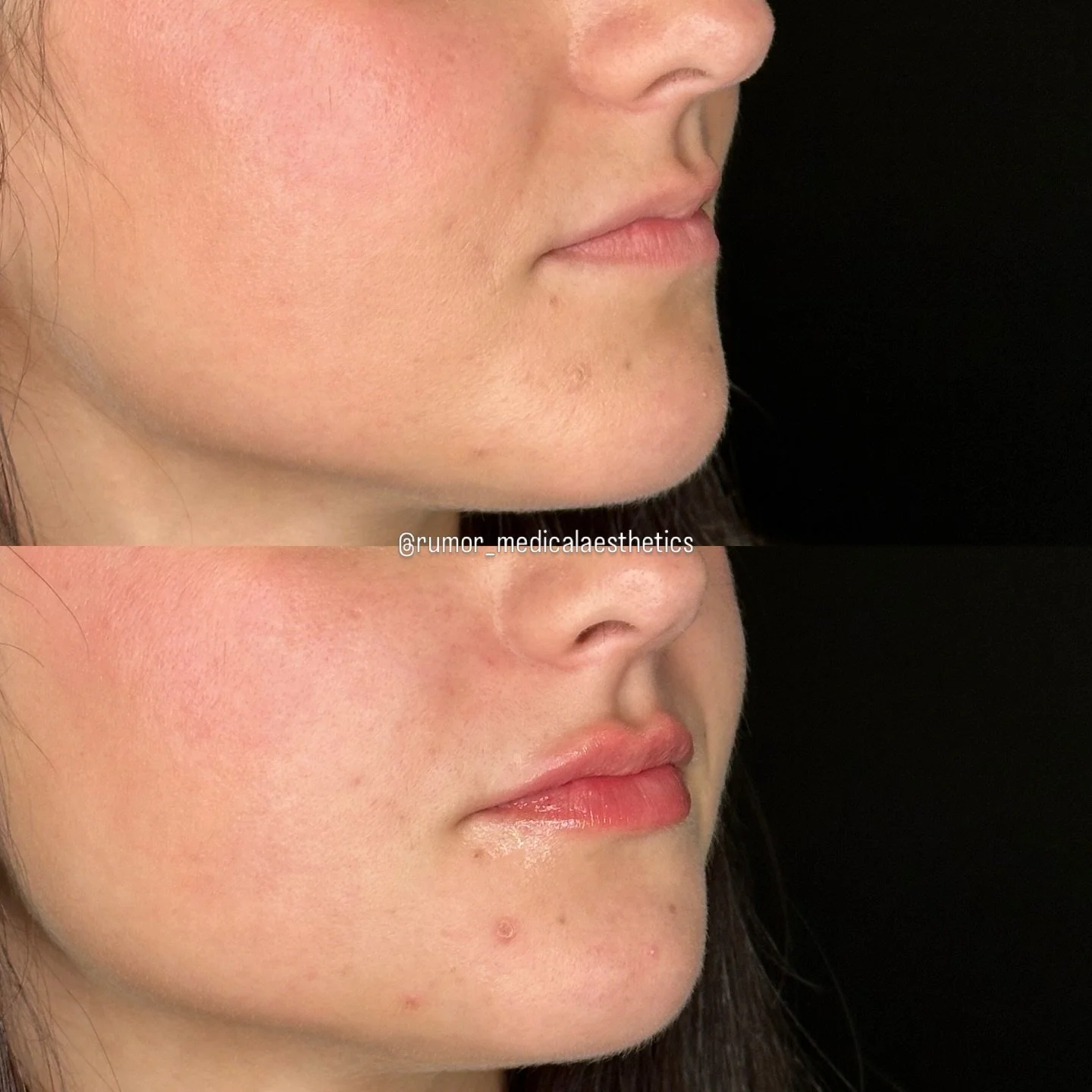 Wondering what a half syringe of lip filler can do? 👀

Just a little perk up while still looking super natural! 

This month you can treat yourself to our Polish &amp; Plump special which includes a half syringe of lip filler and our cult favorite R