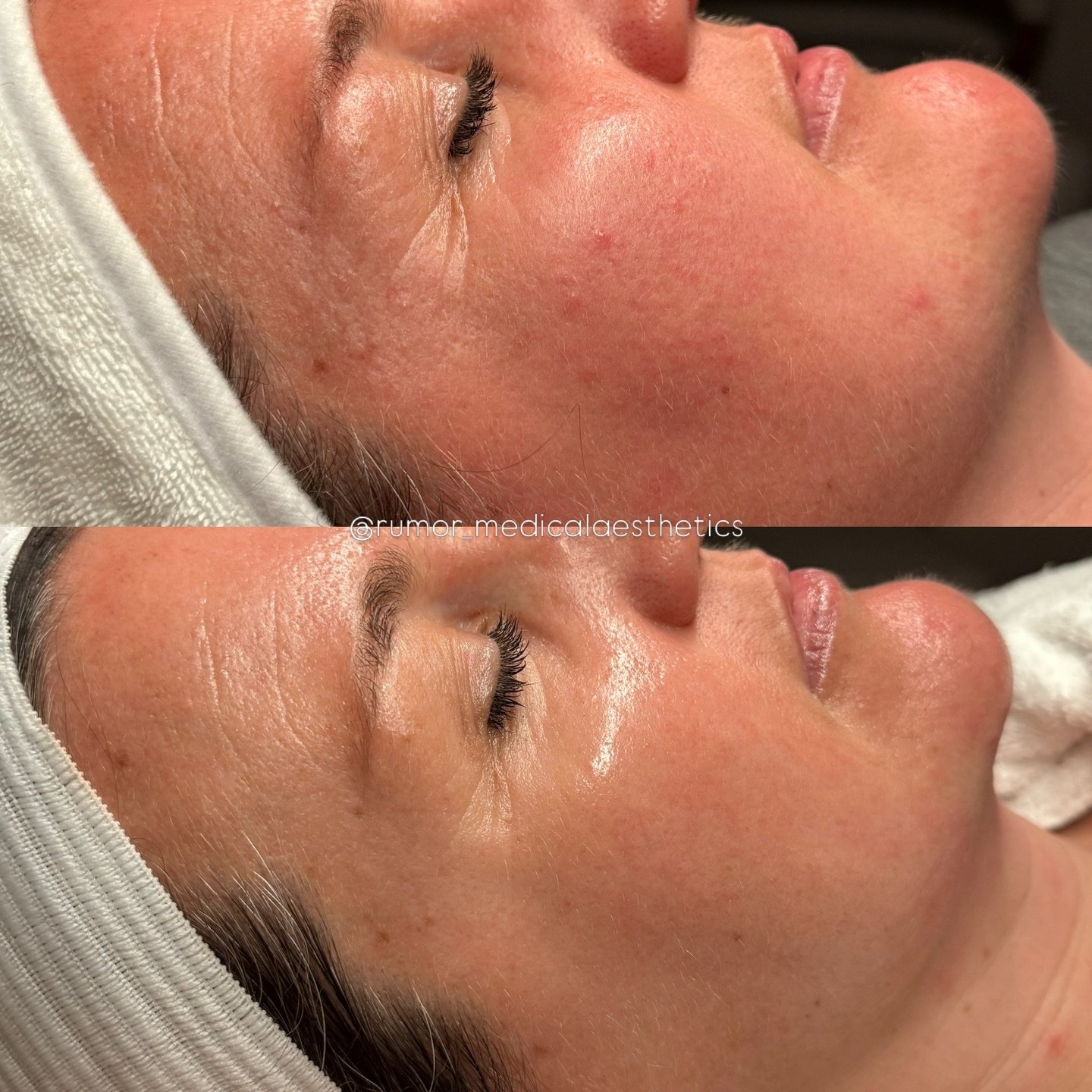 Stop fighting your skin&mdash;start listening to it.

Breakouts, texture, &ldquo;large&rdquo; pores? The instinct is to go aggressive&mdash;but barrier repair has to come first.

Dehydrated skin can&rsquo;t hold water, so it overcompensates by produc