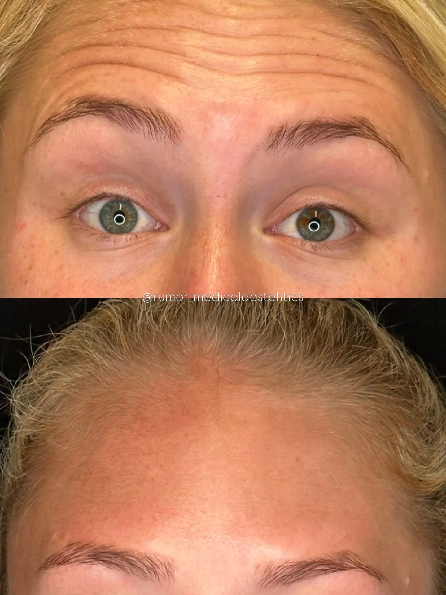 3 cheers for perfectly placed tox! 💉💉💉

Think of it as a little tune-up&mdash;softening lines, keeping things smooth, and letting your natural expressions still shine through. The goal? Refreshed, not overdone.

✨ Why people love it:
&bull; Quick 