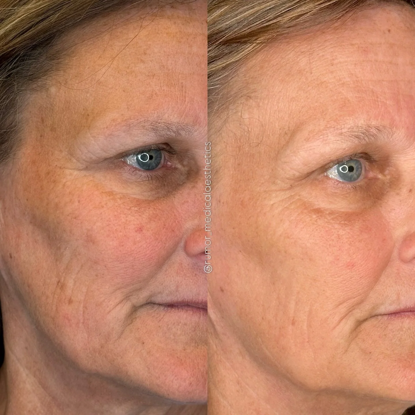 Before ➡️ After ✨

Proof that now&rsquo;s the time to hit reset on your skin👀

This is our cult favorite laser treatment [The Rumor Reset] &mdash;powered by the 1927 nm thulium wavelength&mdash;to target years of accumulated sun damage, uneven tone,