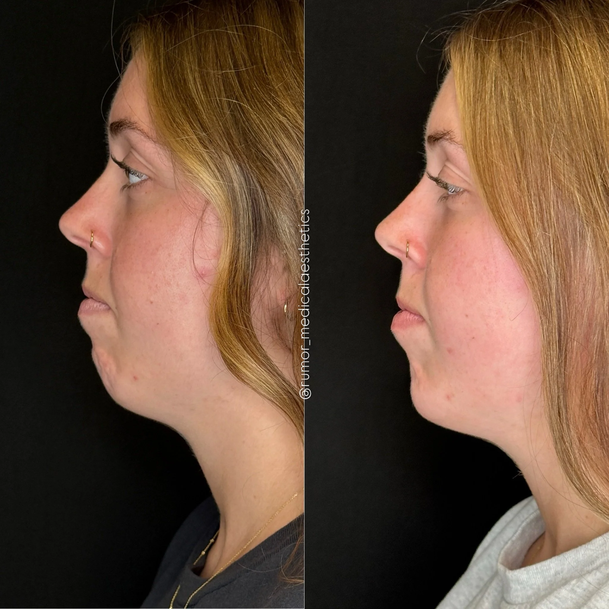 Let&rsquo;s talk chin tox and chin filler 💉

For this patient, we combined a small amount of chin filler with neurotoxin to refine both the shape and movement of the chin.

In her before photo, the mentalis muscle was overactive, creating dimpling a