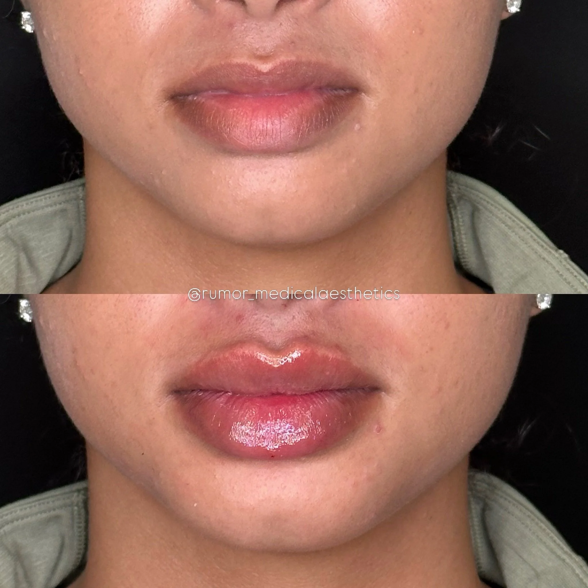 I mean do we even need a caption? These lips don&rsquo;t lie 😘

✨Rumor Medical Aesthetics 
📍Rock Hill, SC
📲 803-919-1958
🕸️ www.rumoraesthetics.com

💉Lynda Marovich, MSN, FNP-BC
@lynda.therumornp 
⚡️Dana Dowdy, RN, LE
@aesthetician.dana 

#fyp #