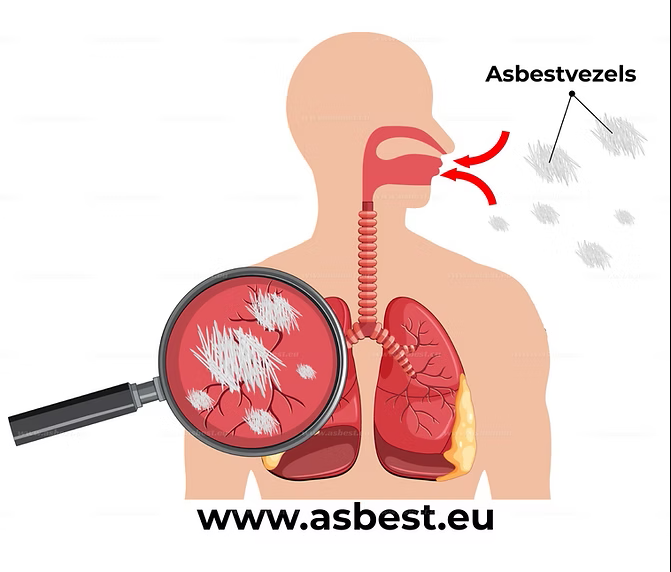 Nieuwe hoop voor patiënten met asbestkanker: veelbelovende resultaten met nieuw medicijn