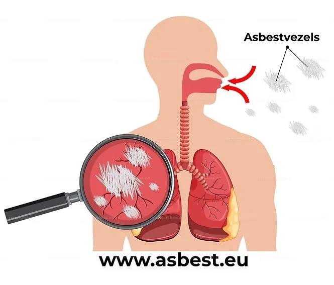 Asbest: Ziektes door asbest