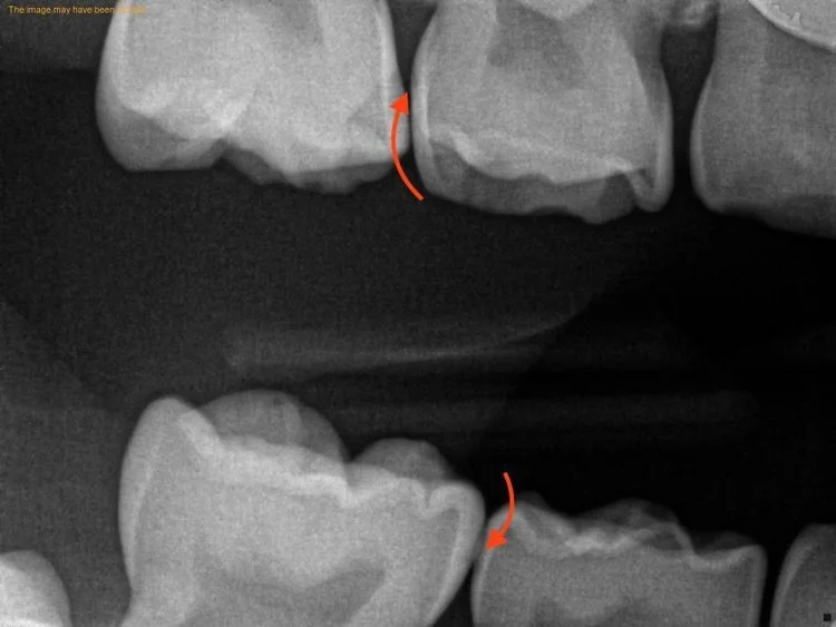 Why do we take x-rays?