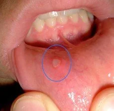 Canker Sores vs. Cold Sores: what's the difference?