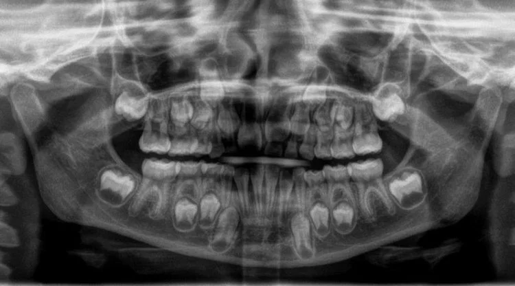 Dental X-rays