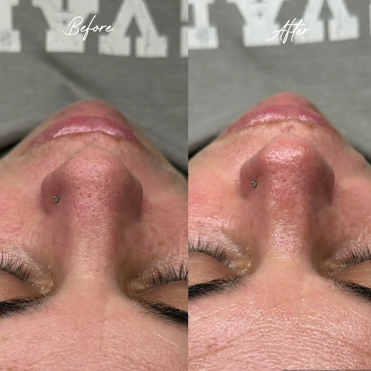 🌱 BioRePeelCI3 Results 🌱
After just one treatment with extractions, congestion and blackheads are visibly reduced while hydration levels are boosted. Fresh, smooth + glowing skin unlocked ✨