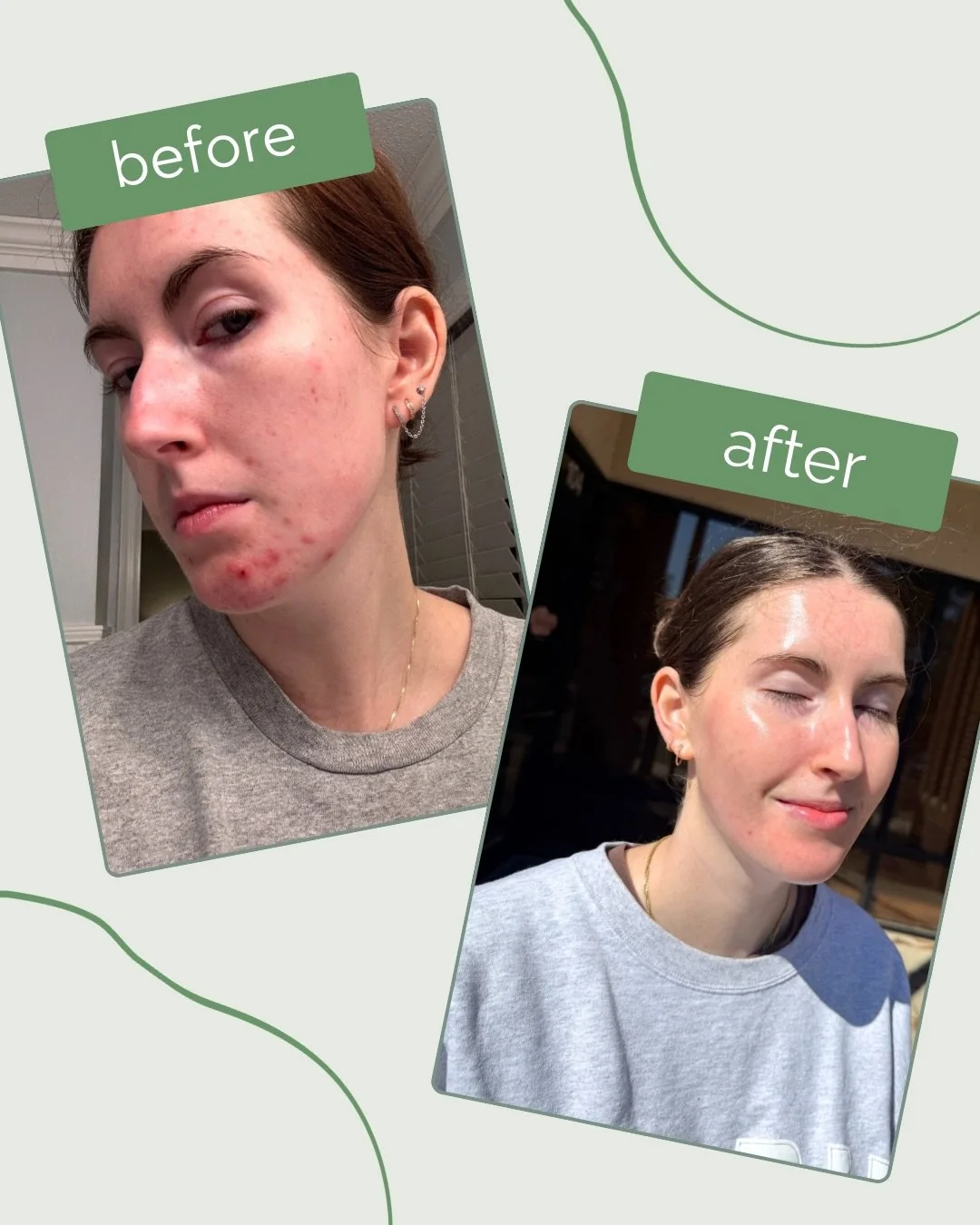 Check out these two recent before and afters. 👀

Real skin. Real progress. Real results. These kinds of changes come from intentional treatment plans, consistency, and giving your skin the support it needs along the way. ✨

#skincaretreatment #befor