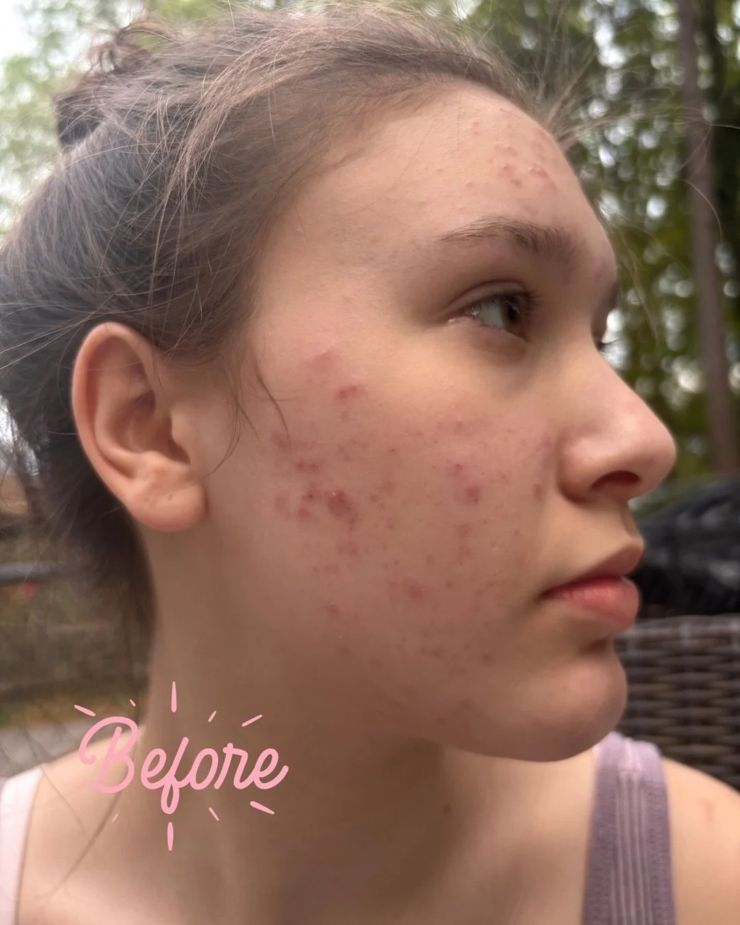 This is what consistent acne treatment looks like. 🤍 Zakk worked with this client to create a treatment plan tailored to their skin, and the results are proof that the right approach makes all the difference. 

Clearer, calmer, more confident skin w