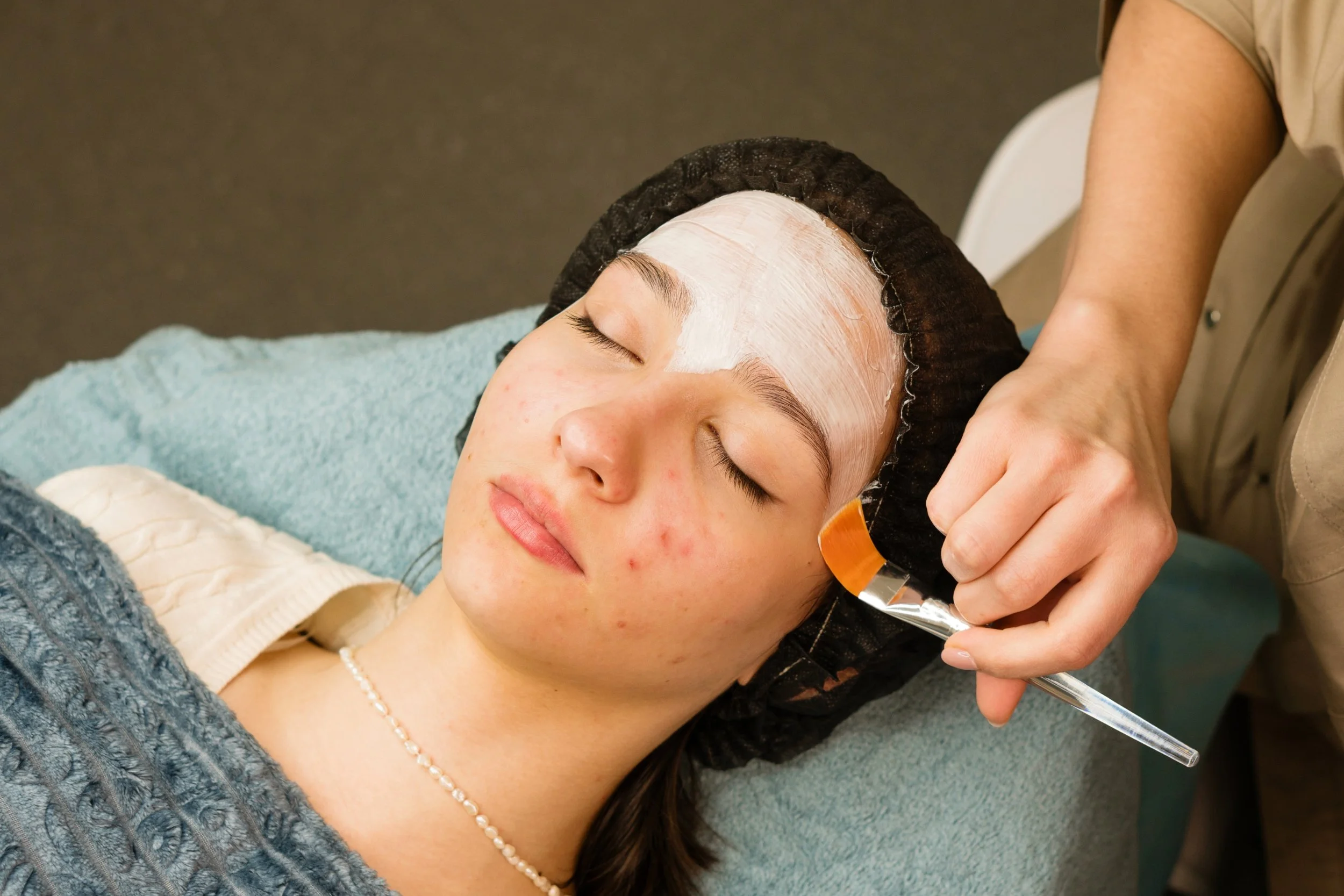 acne facial winston salem nc