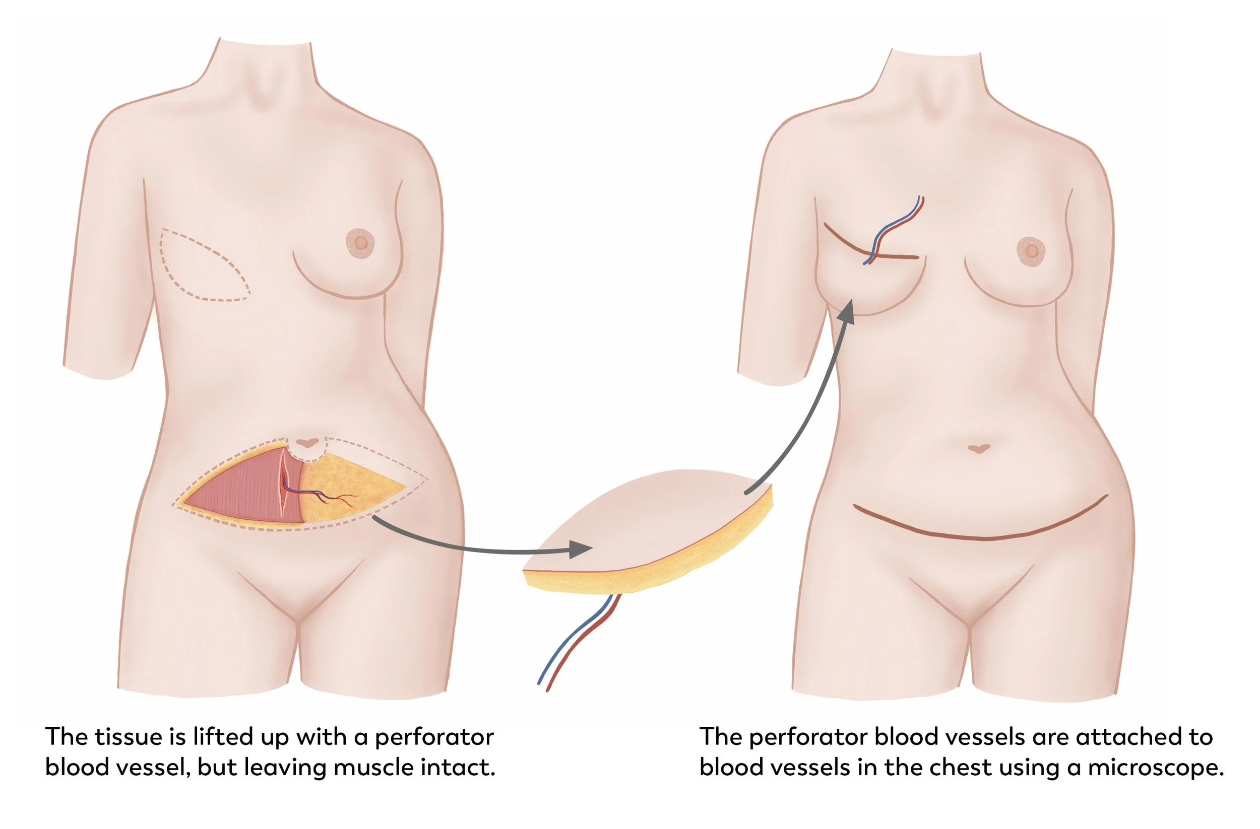 Deip Flap Breast Reconstruction Randwick Plastic Surgery