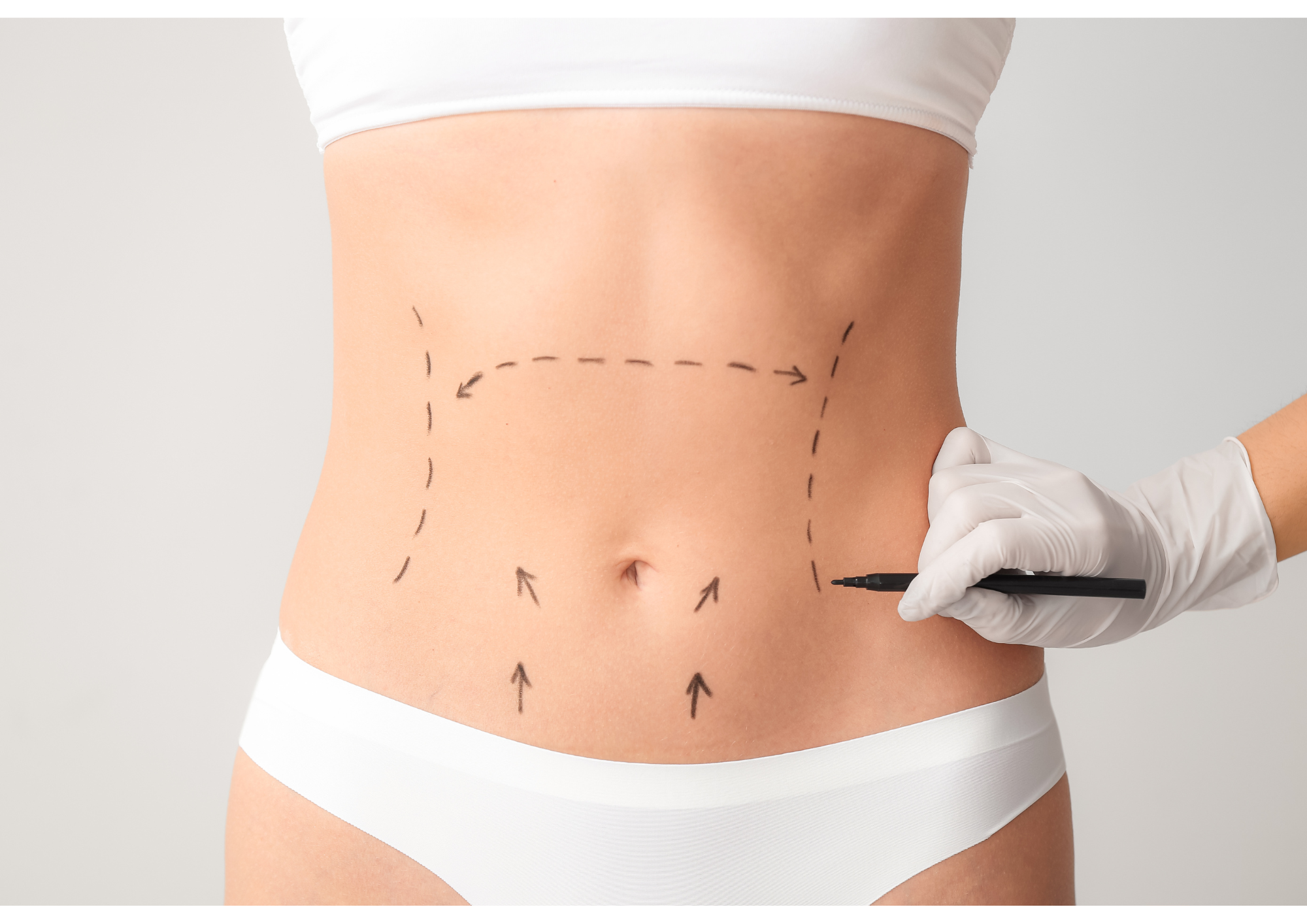 Abdominoplasty 101 - Some things you need to know