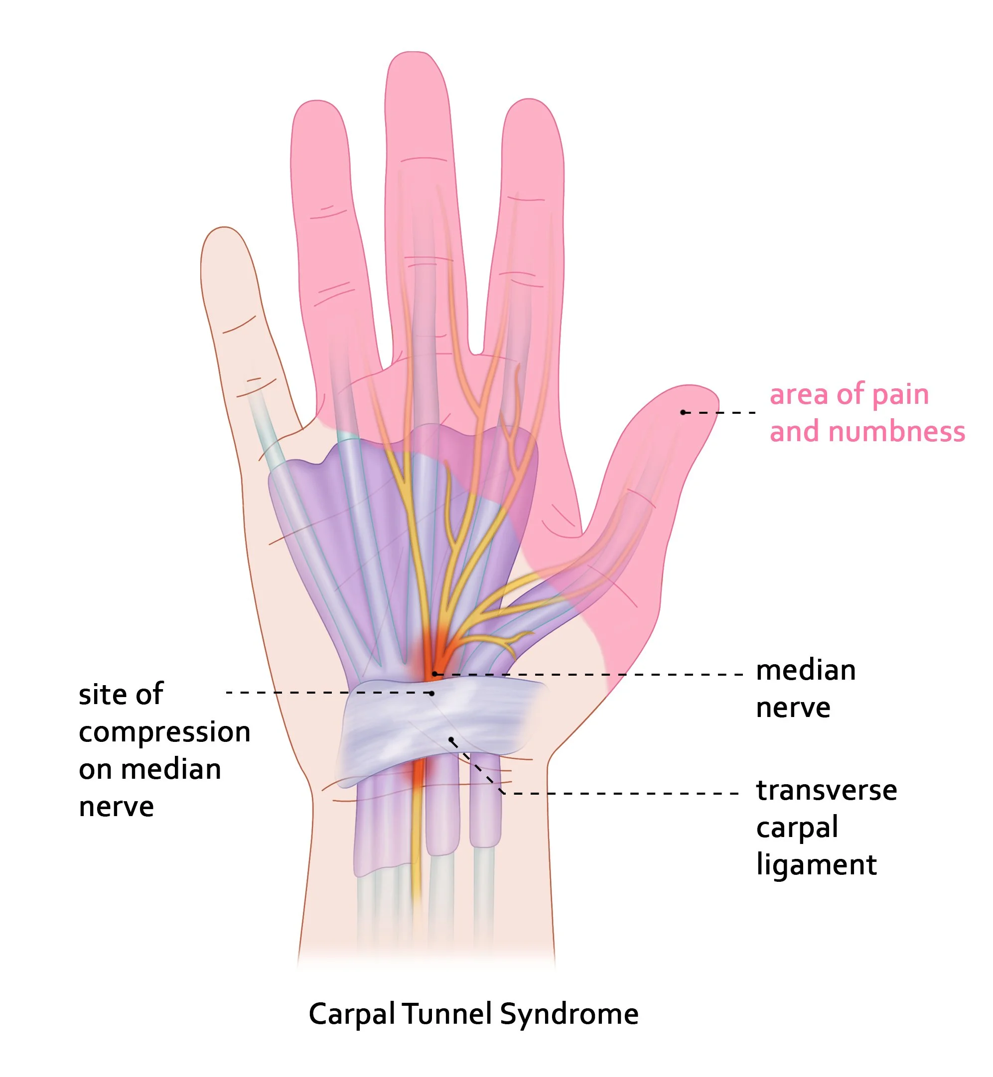 What is Carpal Tunnel syndrome and how best to treat it?