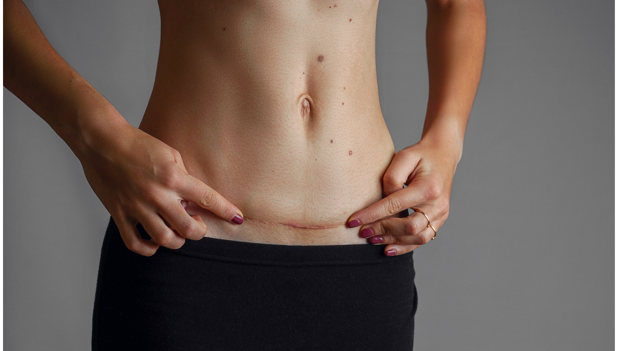 When should I have Scar Revision Surgery?