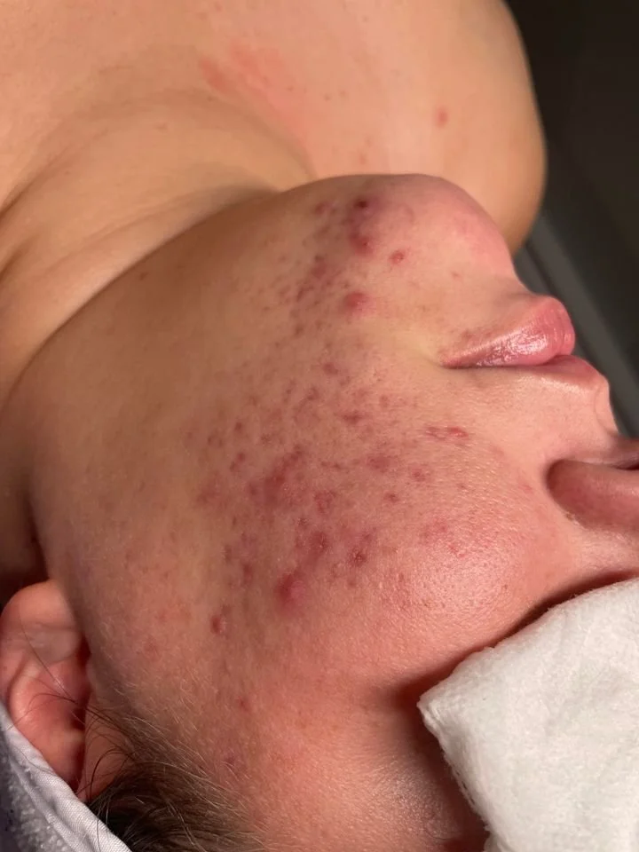 Close-up of a person's face showing acne and skin irritation.