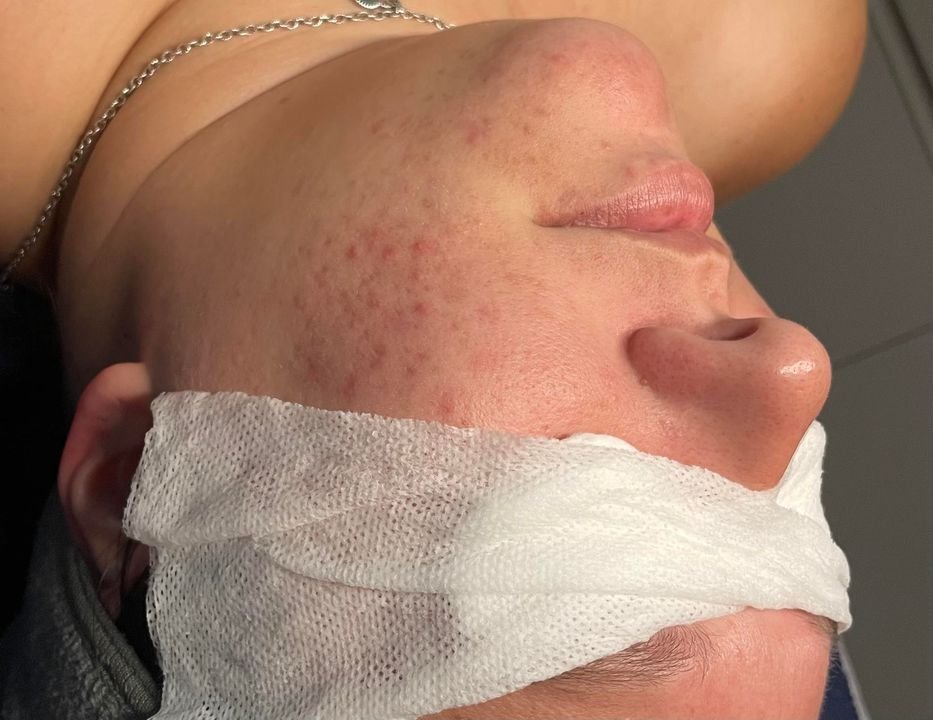 Close-up of a person's face with acne scars, lying down with eyes closed, partially covered with a white cloth or bandage on the chin.