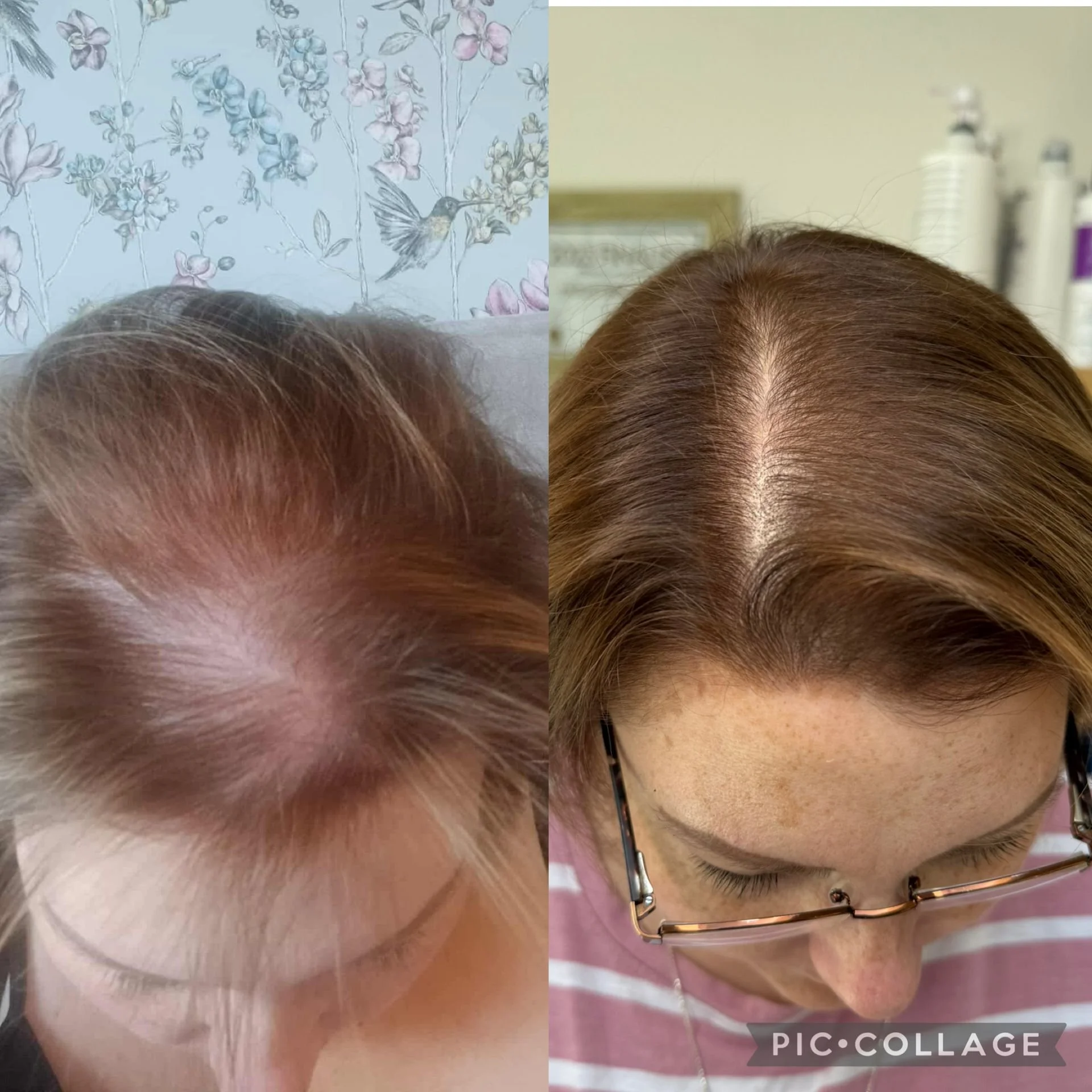 Comparison of a woman's scalp before and after hair treatment, showing fuller, healthier hair after.