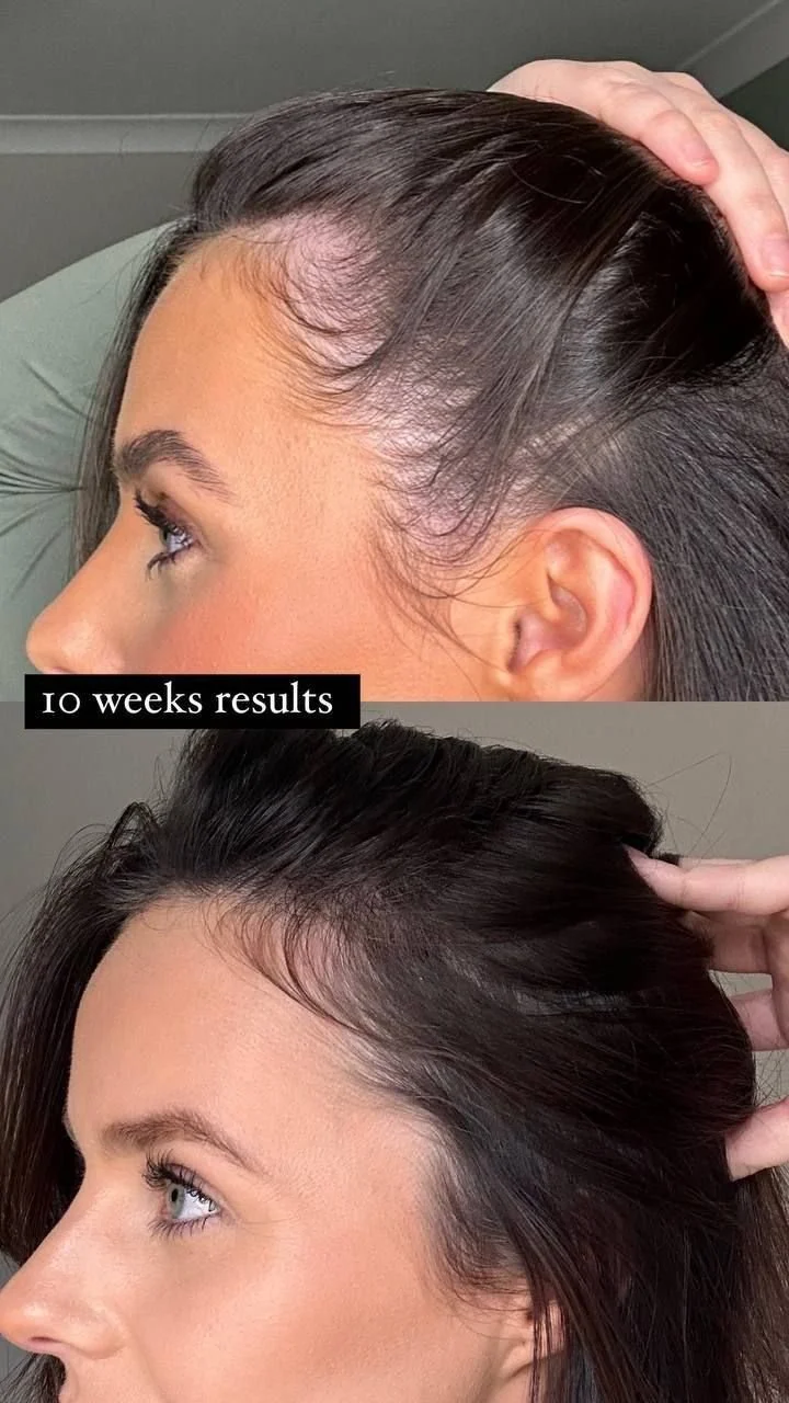 Comparison of a woman's hair before and after 10 weeks of hair growth treatment, showing increased hair length and density.