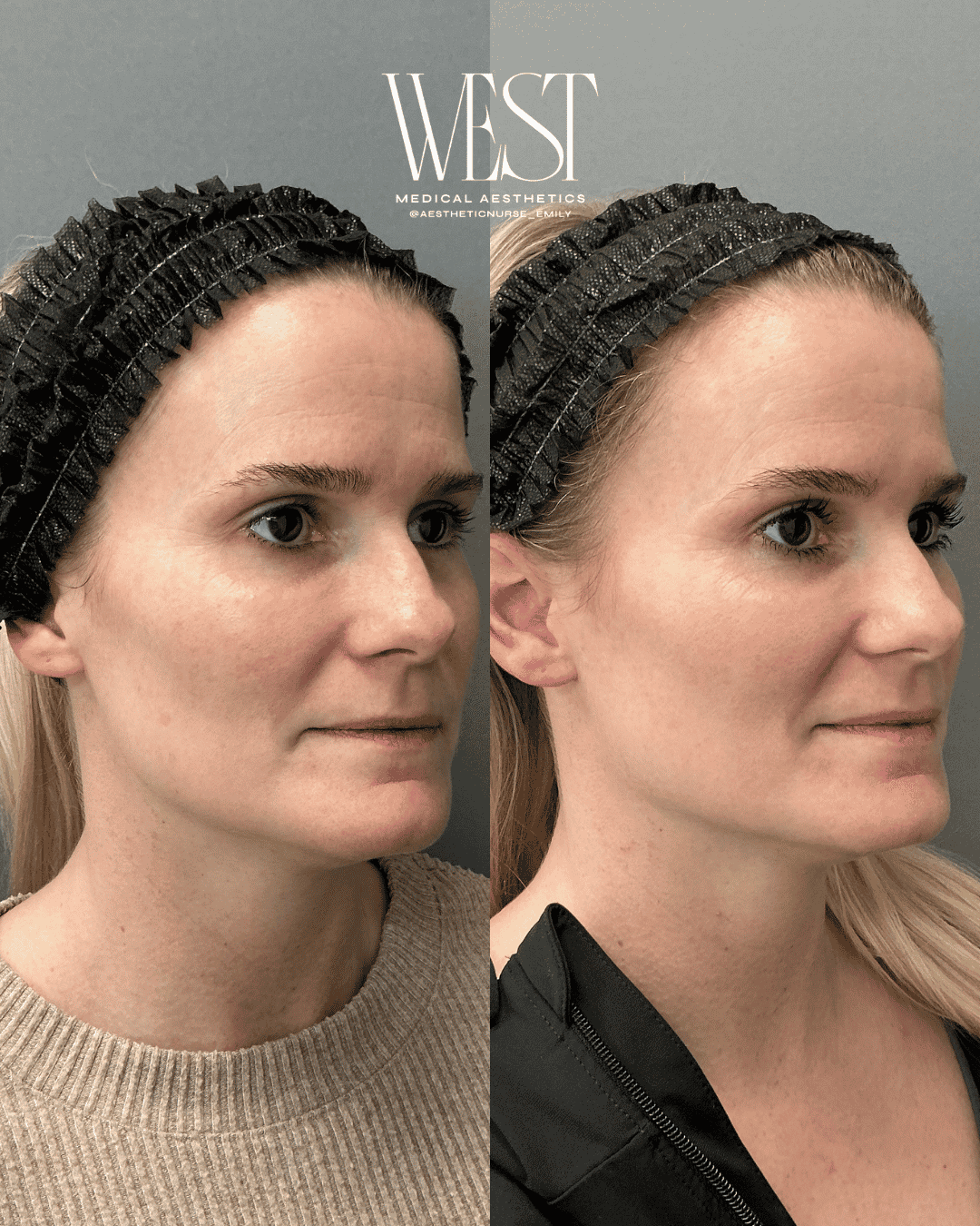 Moxi laser skin treatments in OKC
