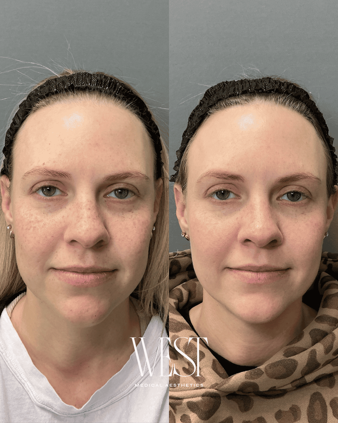 Acne scar treatment in okc