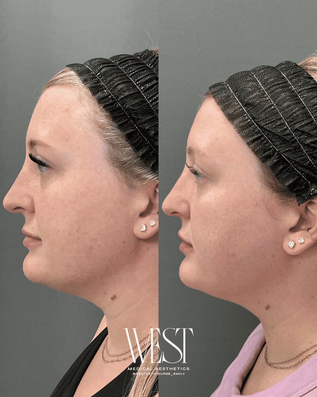 Laser skin treatment in oklahoma city