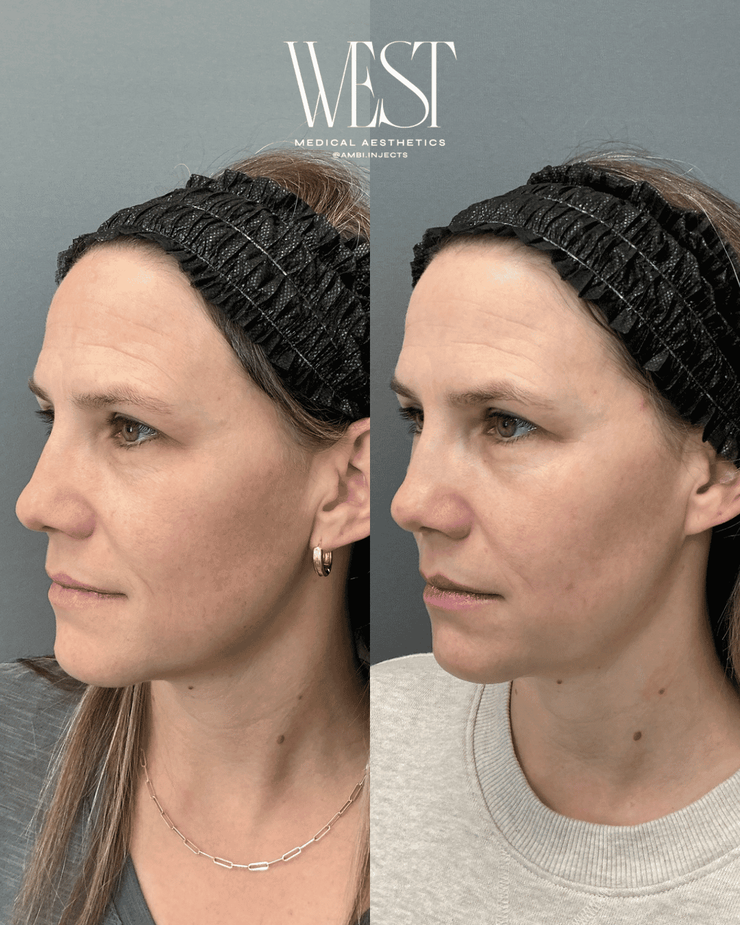 Laser skin treatment in oklahoma city