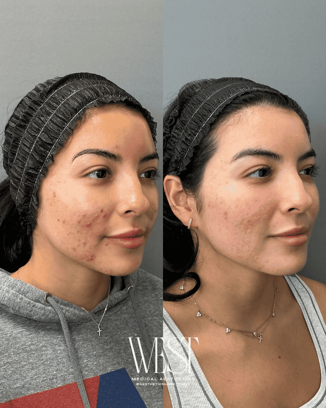 Acne scar treatment in okc