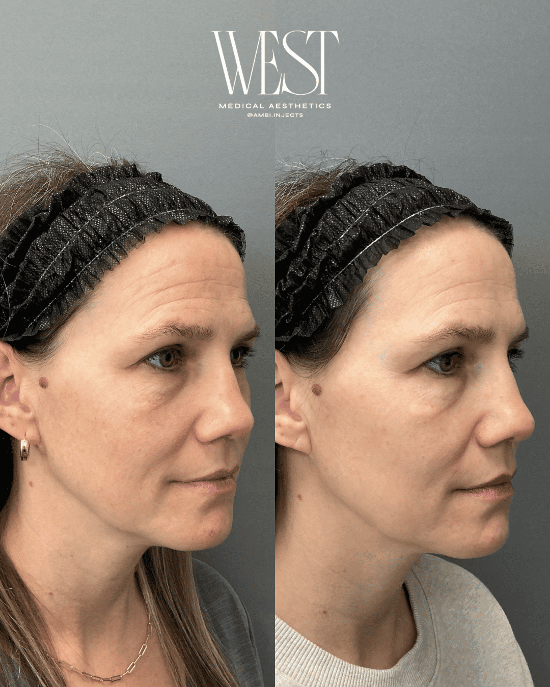 Laser skin treatment in oklahoma city